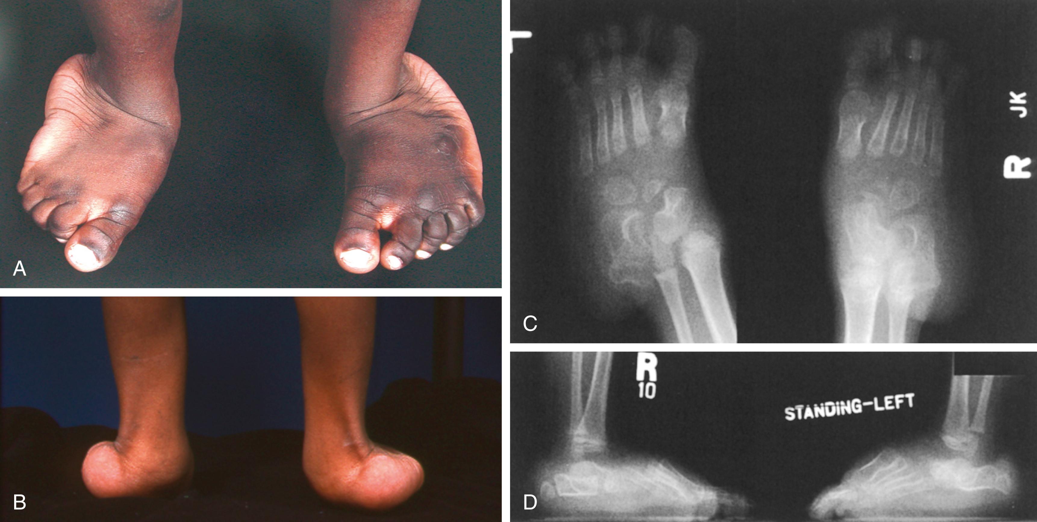 FIG. 37.25, Foot deformities in Larsen syndrome. (A and B) Equinovalgus feet. The hindfoot valgus is exacerbated by the extreme ligamentous laxity. Mild metatarsus varus may be present on the left in (A). (C) Anteroposterior radiographs show shear dislocation of the talocalcaneal joints. (D) Lateral radiographs show marked hindfoot valgus and accessory calcaneal apophyses. The patient was asymptomatic.