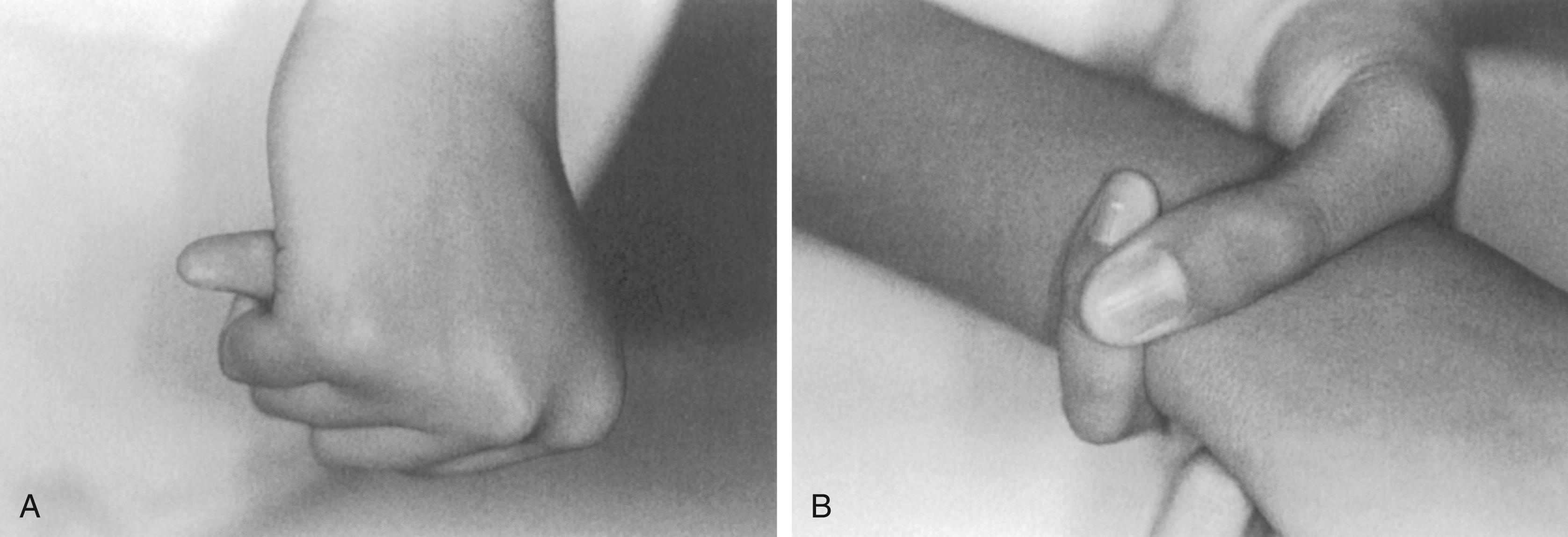 FIG. 37.3, Clinical signs suggestive of, but not pathognomonic for Marfan syndrome. They result from a combination of joint laxity and long limbs or arachnodactyly. (A) Thumb sign. With the thumb opposed across the palm and the fingers flexed over the thumb, the distal phalanx of the thumb protrudes beyond the ulnar border of the hand. (B) Wrist sign. When the patient encircles the opposite wrist with the thumb and small finger, these digits overlap at least to the distal interphalangeal joint of the small finger.