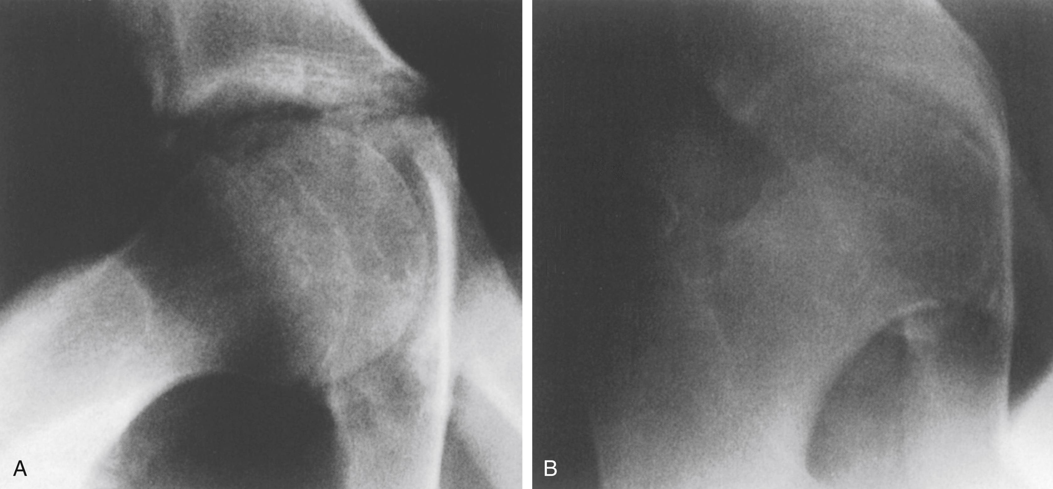 FIG. 37.4, Protrusio acetabuli in a 14-year-old boy with Marfan syndrome. (A) Note the crossing or collapse of the acetabular teardrop. Pain and stiffness of the hip were the presenting manifestations in this patient. (B) Radiographic appearance 1 year after surgical closure of the triradiate cartilage, as described by Steel. 89 There was significant resolution of pain and stiffness.