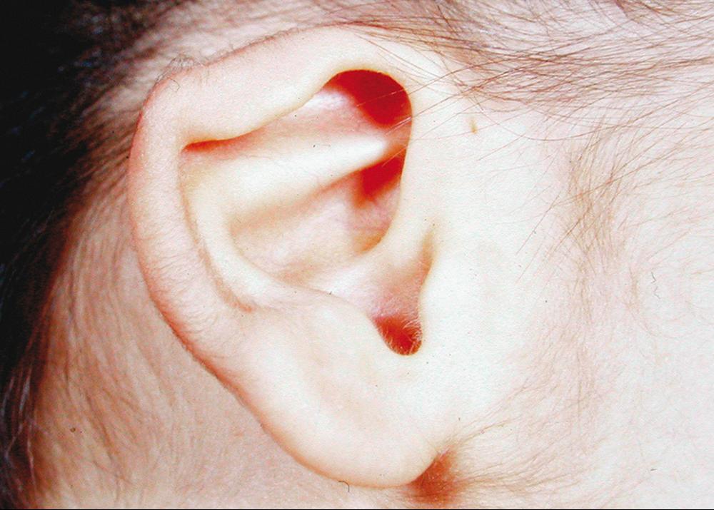 FIG. 37.5, Infant with congenital contractural arachnodactyly (Beals syndrome). The crumpled appearance of the external ear is typical of this disorder.