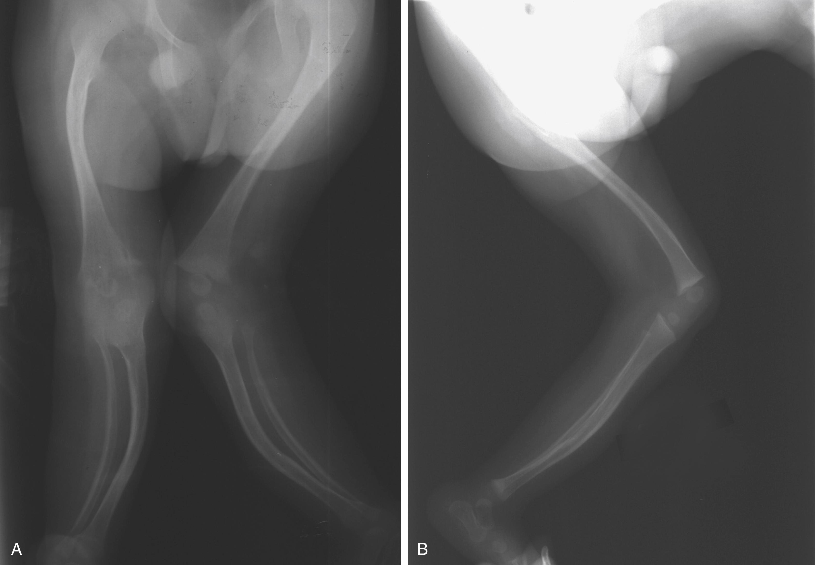 FIG. 37.9, (A) Marked bowing and osteopenia in a patient (also shown in Fig. 37.6) with residual knee flexion contractures. The appearance is reminiscent of osteogenesis imperfecta. (B) Fixed flexion deformity of the knee.