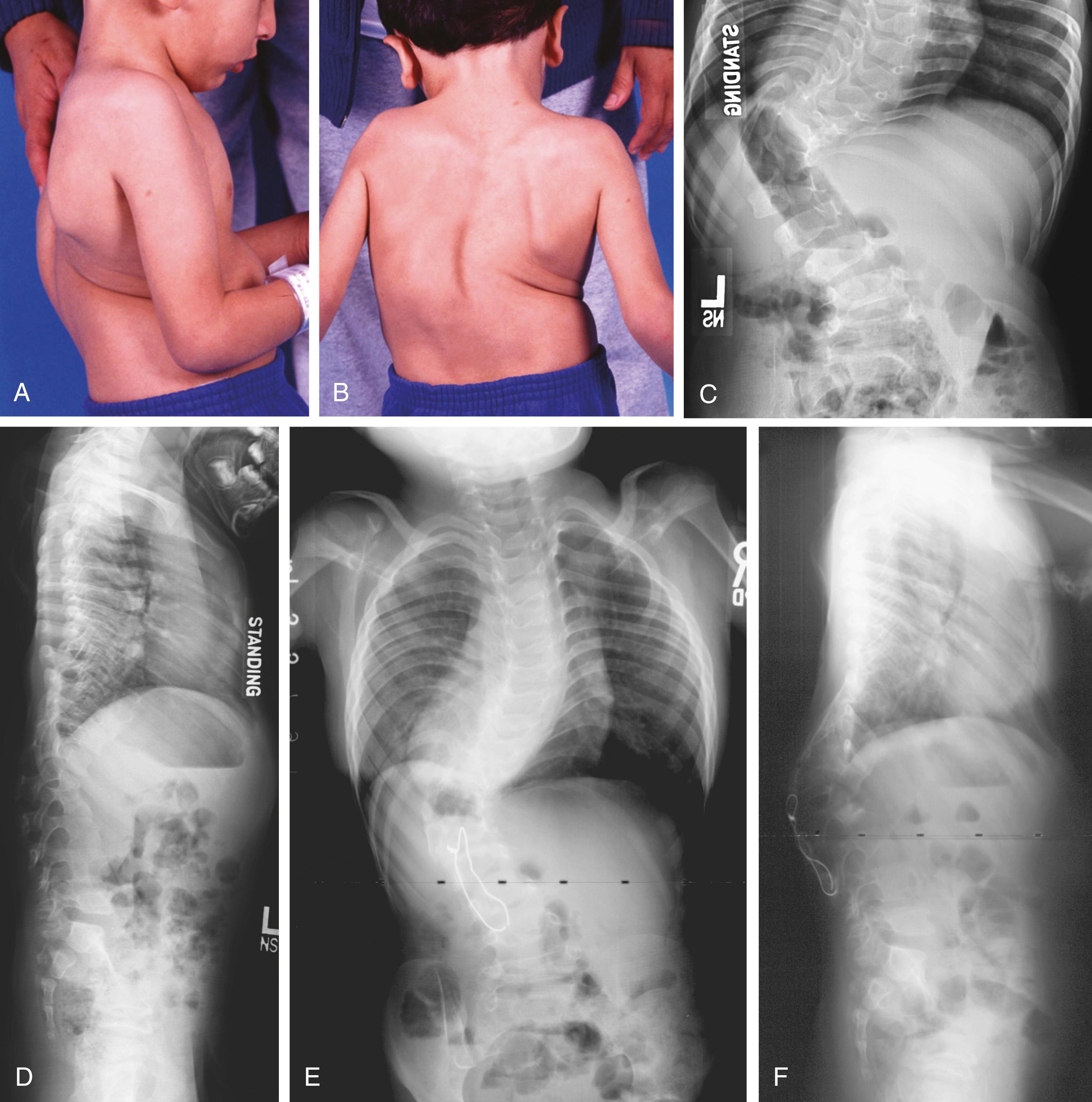 FIG. 37.10, (A and B) A 2-year-old boy with congenital contractural arachnodactyly (Beals syndrome) and thoracolumbar scoliosis. (C and D) Radiographs demonstrate dysplastic vertebrae and sagittal plane deformities. (E and F) The patient at age 3 years, 1 year after anterior and posterior fusion with pediatric instrumentation. Because of wound dehiscence, the instrumentation became exposed and had to be explanted, with resulting pseudarthrosis and loss of correction. (G and H) The patient at age 4 years 2 months. He underwent anterior and posterior osteotomies and revision of instrumentation. (I and J) The patient at age 6 years. The convex rod was removed 1 year postoperatively because of prominence and skin erosion. The fusion mass appeared solid, and no further deformity has recurred.