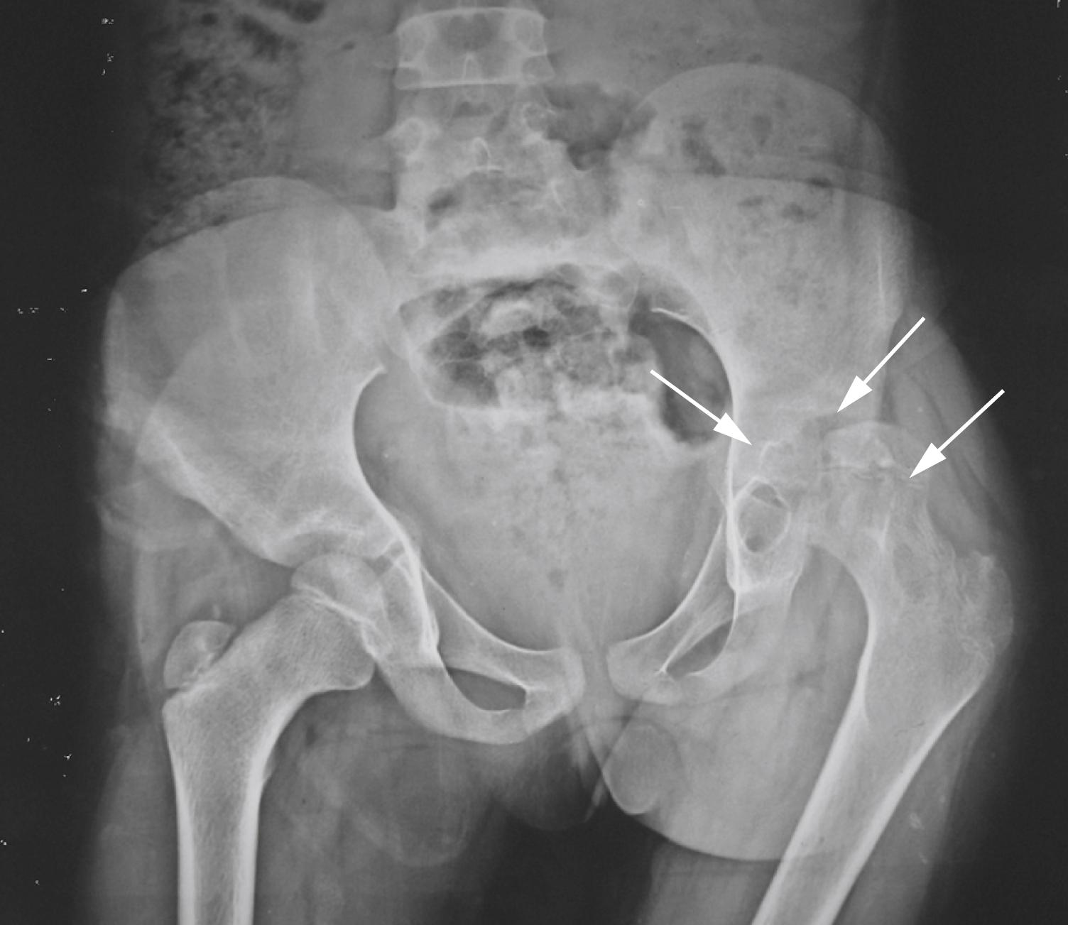 Fig. 28.12, Tubercular arthritis of the hip showing lytic areas within the head of the femur and acetabulum. The damaged osteopenic acetabulum has migrated superiorly and the femur is lying adducted with a subluxed head ( arrowed ).