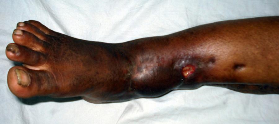 Fig. 28.2, A thickened irregular bone associated with a puckered adherent scar or discharging sinus would be diagnostic of underlying osteomyelitis.