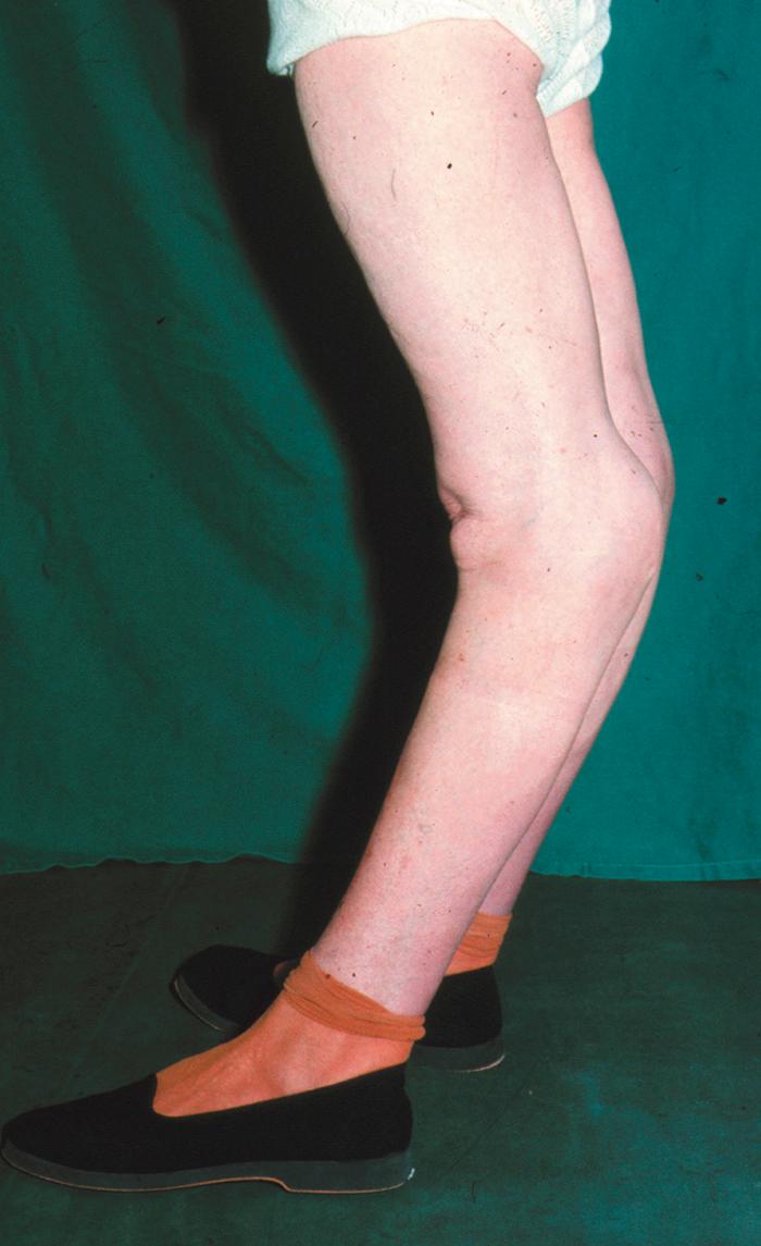 Fig. 28.5, A recurvatum deformity of the knees with hyperextension.
