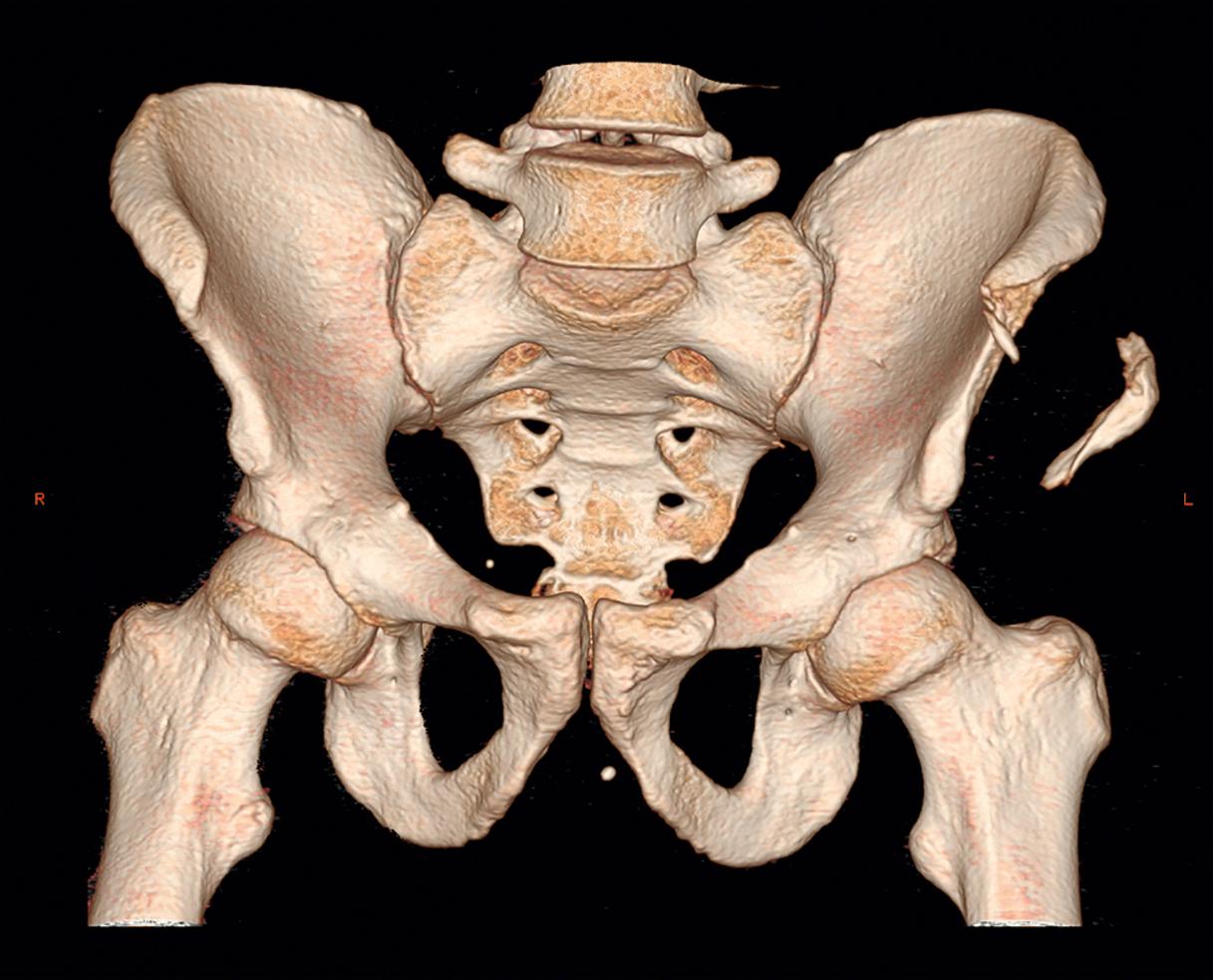 Fig. 28.6, Three-dimensional computed tomography showing an iliac wing fracture.
