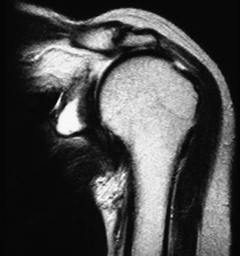 Fig. 28.7, Magnetic resonance image of a shoulder through the level of the acromioclavicular joint and the glenohumeral joint.