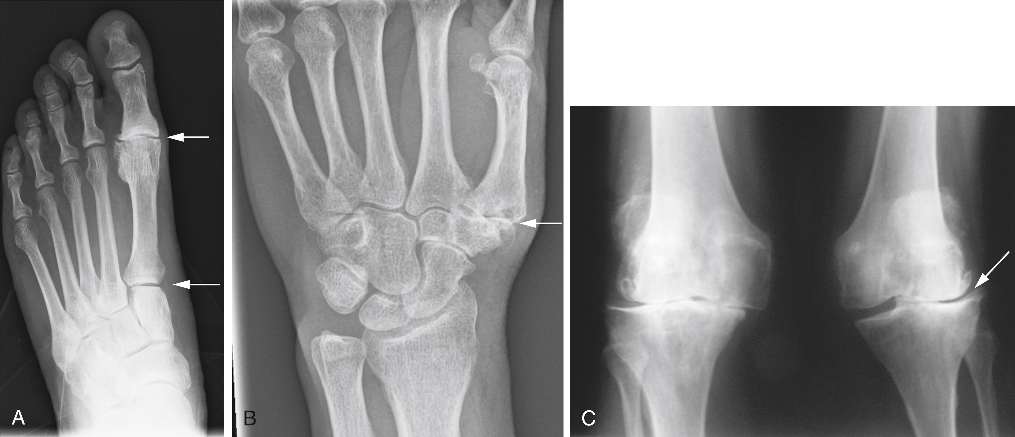 Fig. 28.9, Osteoarthritis can affect any joint.