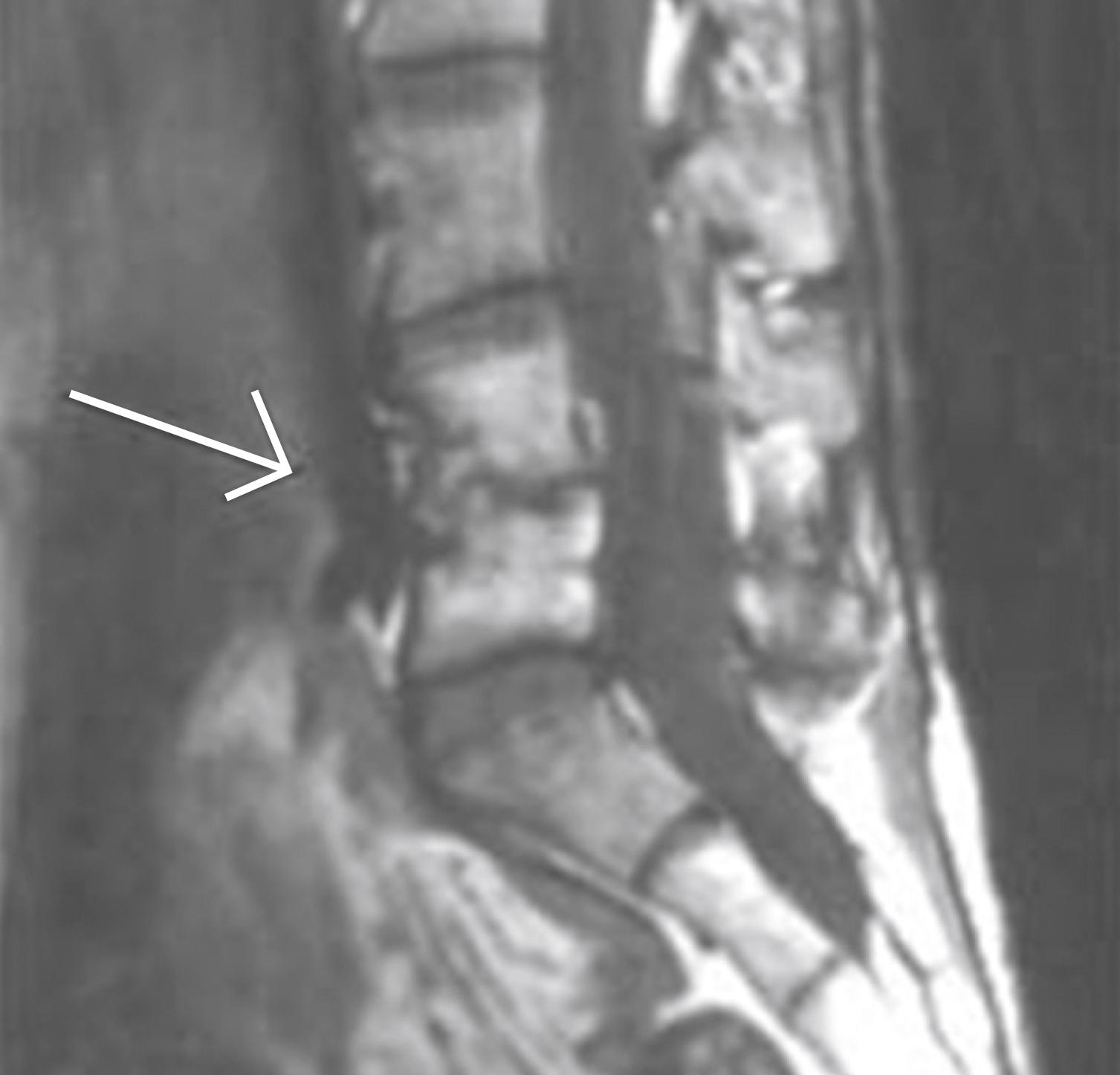 Fig. 28.10, Typically, the paradiscal site on either side of the disc is involved in spinal tuberculosis.