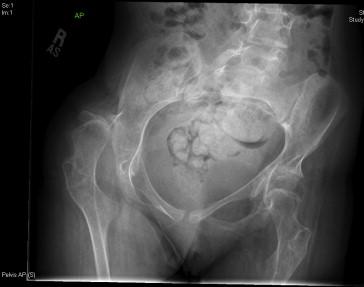 Figure 52.1, A patient with SMA demonstrating dislocation of the right hip and scoliosis of the lumbar spine.