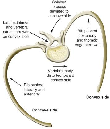 FIGURE 32.2, Characteristic distortion of the vertebra and ribs in thoracic scoliosis.