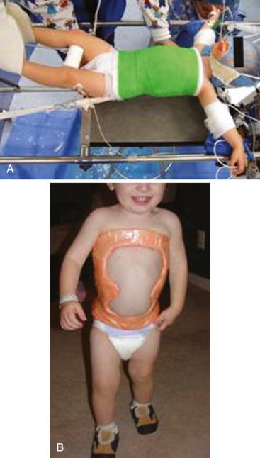 FIGURE 32.3, A, Nonoperative correction of scoliosis in infants and toddlers may be achieved with repeated casting. B, Cutting and trimming of the cast allows correction of the spine while facilitating daily living.