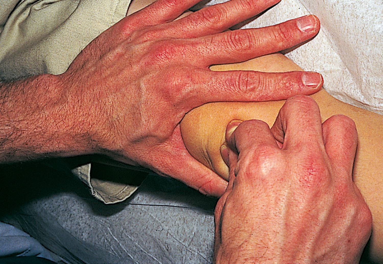 Fig. 22.10, Test for small knee joint effusions. Moderate pressure is applied over the suprapatellar pouch with the thumb and index finger of one hand, milking any fluid present downward. The other hand simultaneously pushes the patella up toward the femur. When an effusion is present, the patella becomes ballotable, and a palpable click is felt as the patella strikes the front of the distal femur.