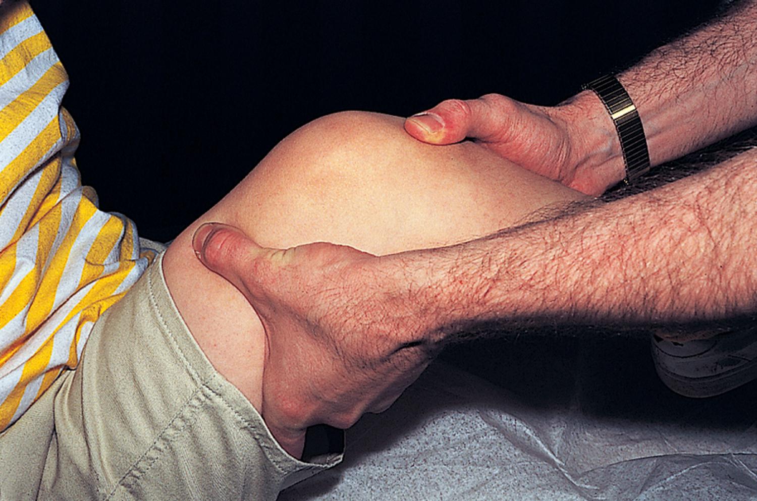Fig. 22.13, Lachman test for anterior cruciate ligament tear. With the knee flexed to 15 degrees, the distal femur is grasped with one hand and the proximal tibia with the other, with the thumb on the joint line. The tibia is moved forward while the femur is pushed backward. Any abnormal displacement of the tibia on the femur indicates anterior cruciate instability and represents a positive test.