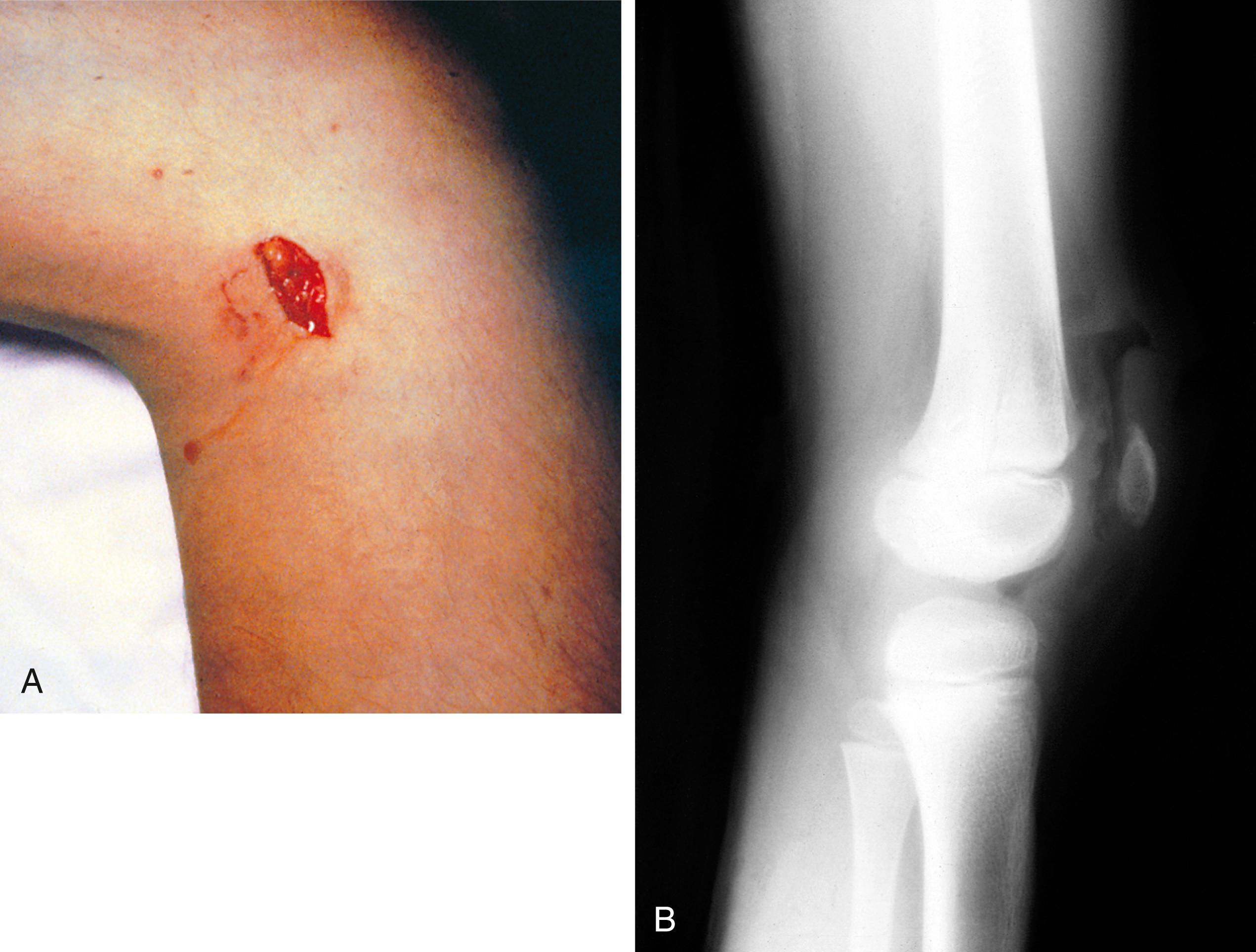 Fig. 22.16, (A) Penetrating injury of the knee. This child was struck by a stone propelled by the blades of a power lawn mower. Although the laceration appeared to be minor, serosanguineous fluid flowed from it on movement of the knee, suggesting penetration of the joint capsule. This was confirmed on exploration in the operating room. (B) Air is seen within the knee joint and in the overlying soft tissues in a child who sustained a deep laceration that penetrated the joint capsule.