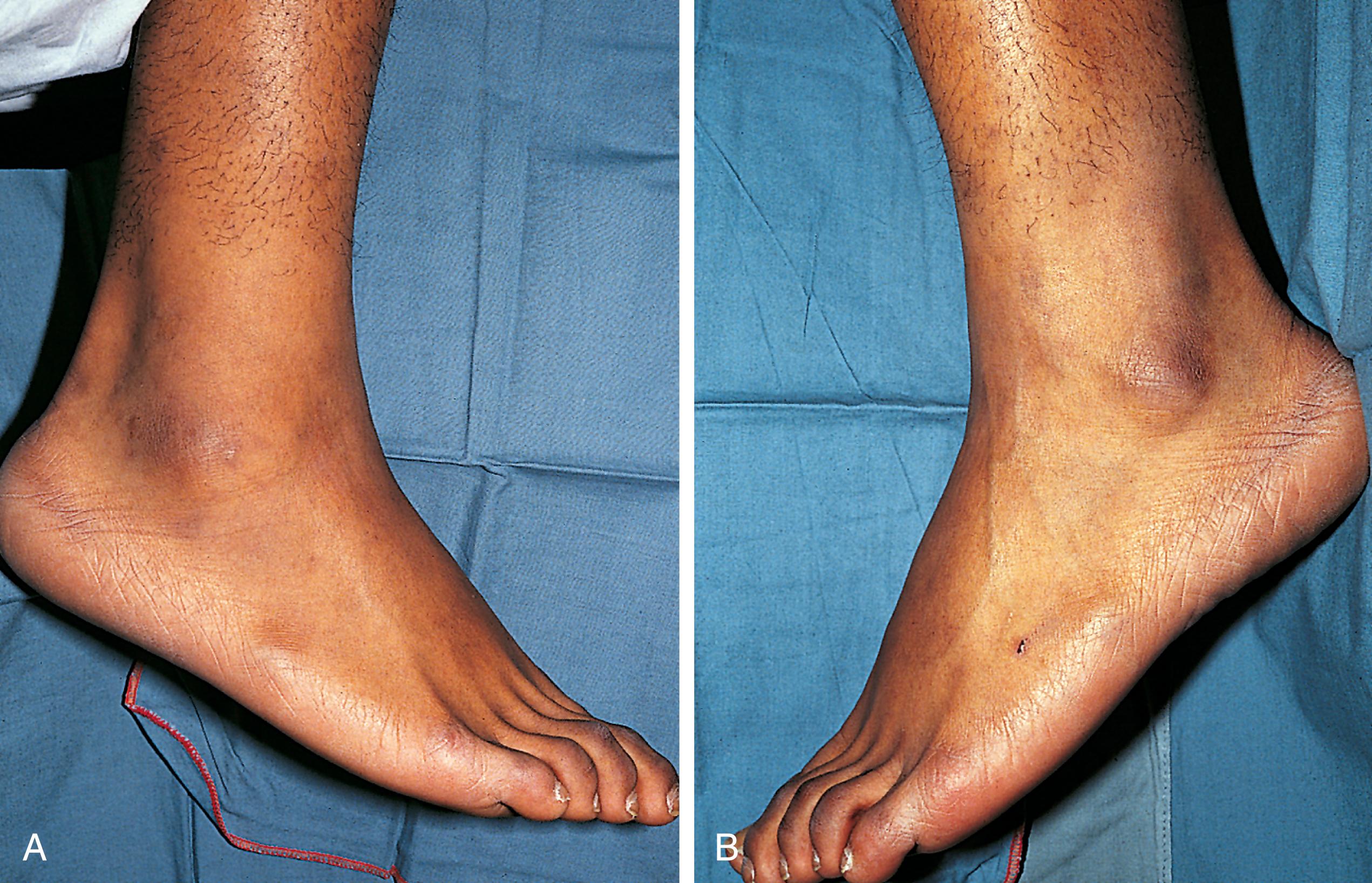 Fig. 22.17, Salter-Harris type I fracture of the distal fibula. (A) Slight swelling is present over the lateral malleolus. The degree of swelling can be truly appreciated only by comparing the injured ankle with its normal counterpart, shown in (B). The patient had point tenderness over the affected malleolus. The findings differ from those seen in an ankle sprain, in which tenderness and swelling are greatest over the ligaments inferior to the malleolus (see Fig. 22.65 ).