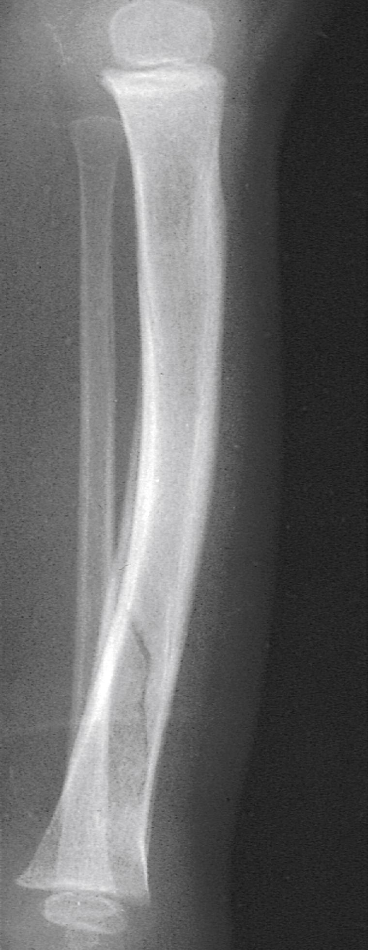 Fig. 22.43, Toddler’s fracture. This spiral fracture of the distal tibia was the result of a fall with a twist. The fracture was invisible when the child was seen initially but is evident along with subperiosteal new bone formation on this follow-up film taken 2 weeks later.