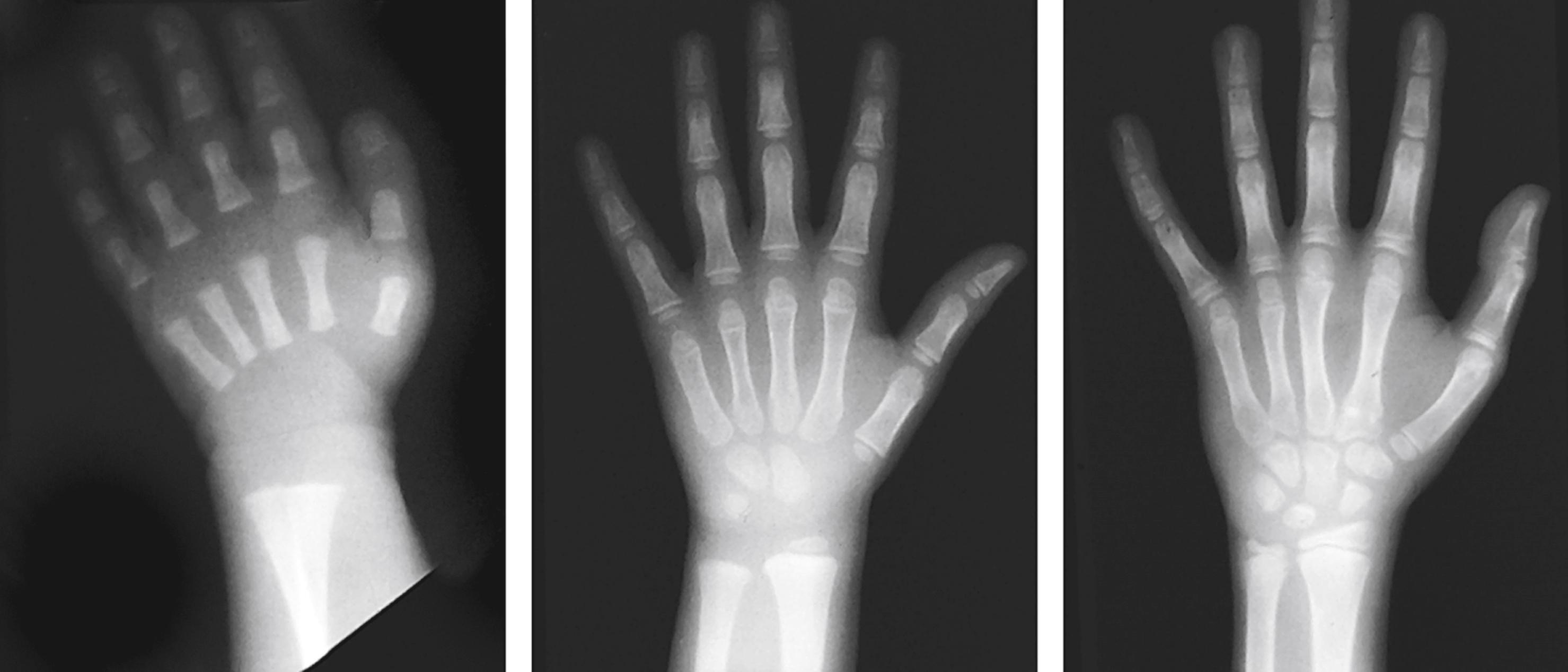 Fig. 22.2, Increasing numbers of ossification centers become radiographically visible with age. From left, the hands shown are those of a toddler, a young school-age child, and a young adolescent. Injuries affecting unossified bones or growth centers are invisible radiographically.