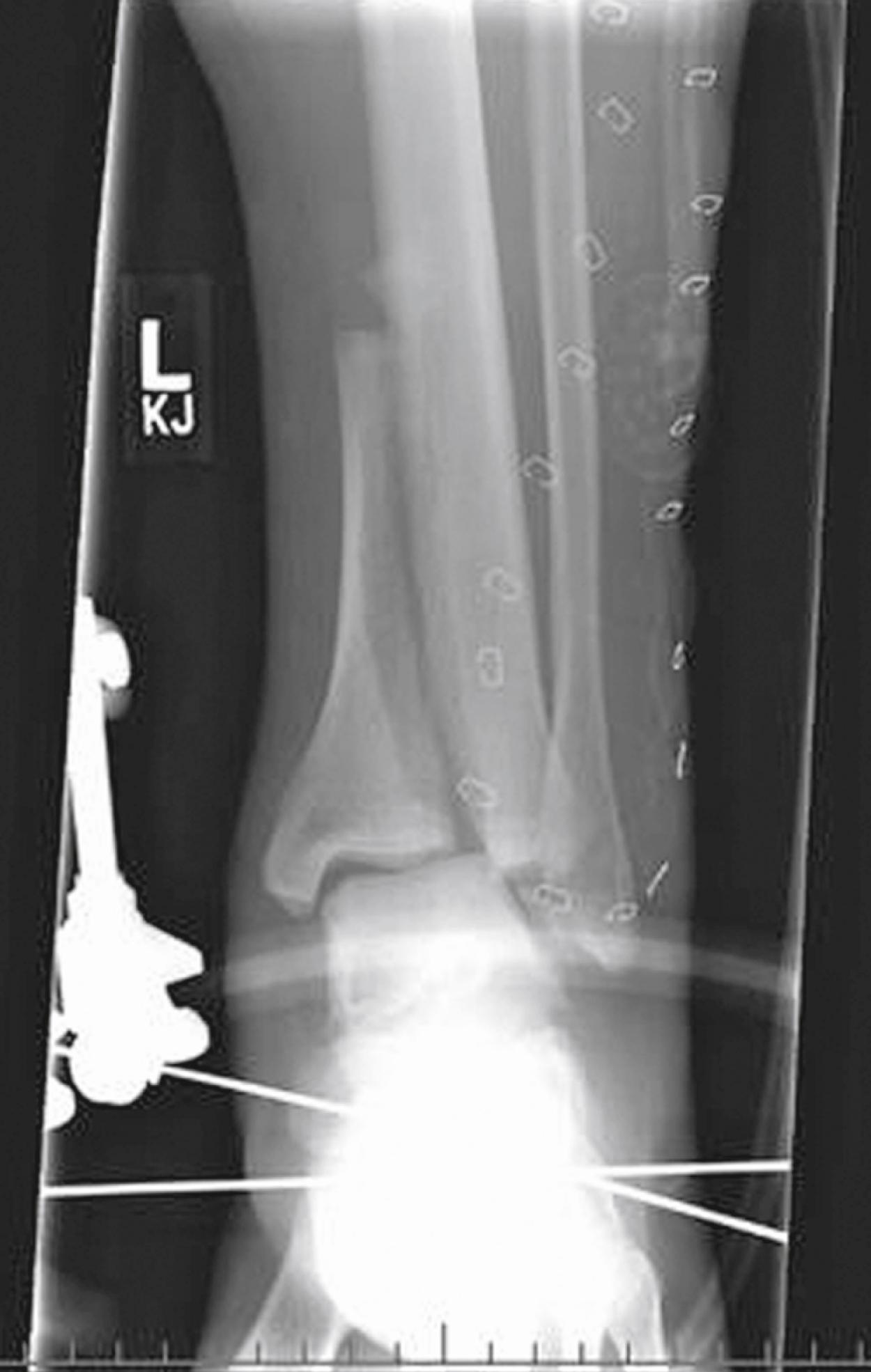 Fig. 22.19, Longitudinal fracture. During a motocross competition this teenager missed a jump and was thrown 20 feet in the air, then fell to the pavement below, landing directly on his foot. The force of the impact was transmitted upward through his ankle, resulting in this vertical tibia fracture.