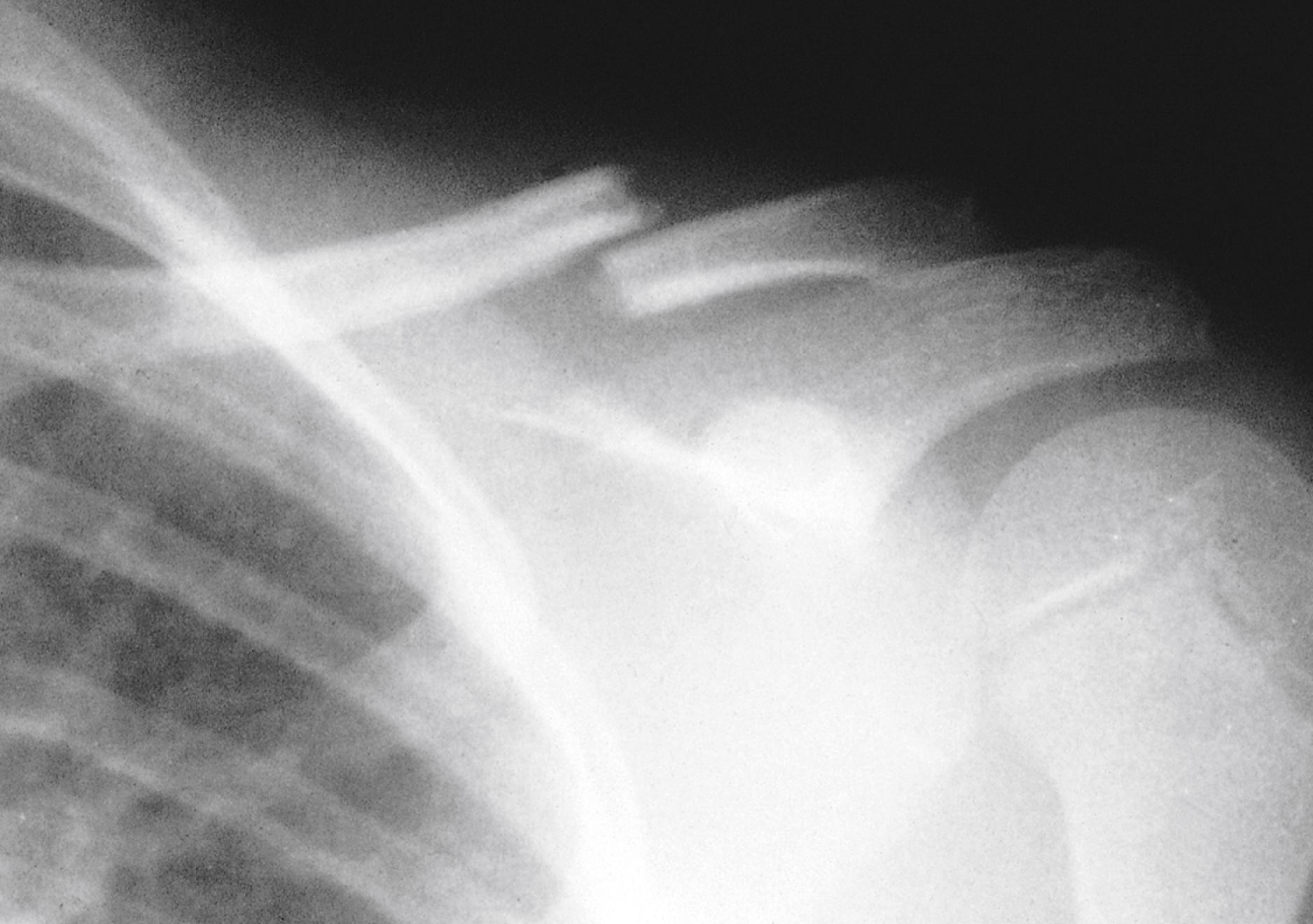 Fig. 22.20, Transverse fracture of the midportion of the clavicle. The fracture line is perpendicular to the long axis of the bone.