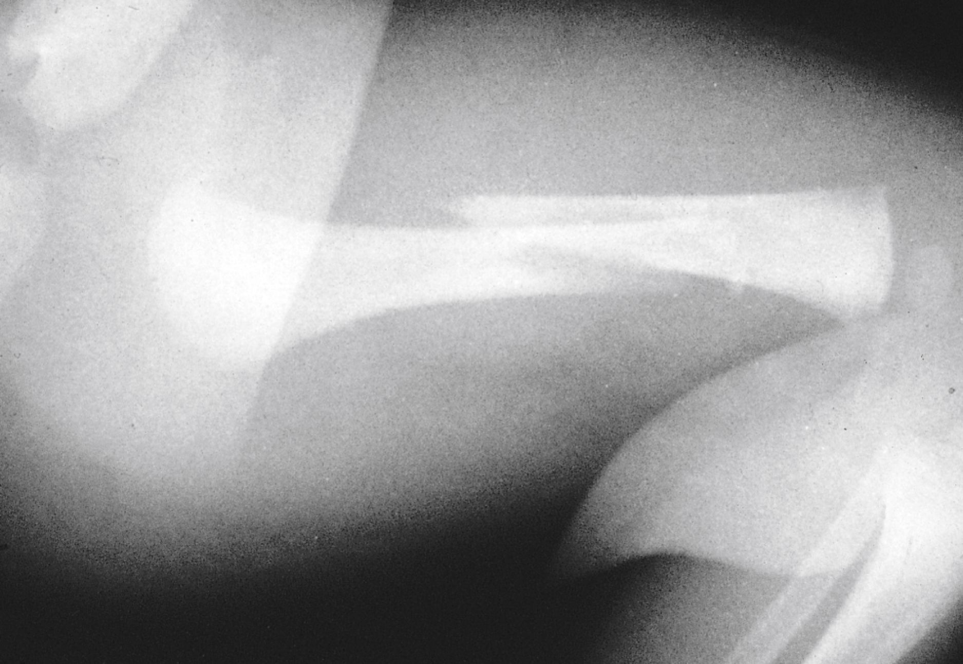 Fig. 22.21, Oblique fracture of the midportion of the femur. The fracture line is angled relative to the axis of the bone.