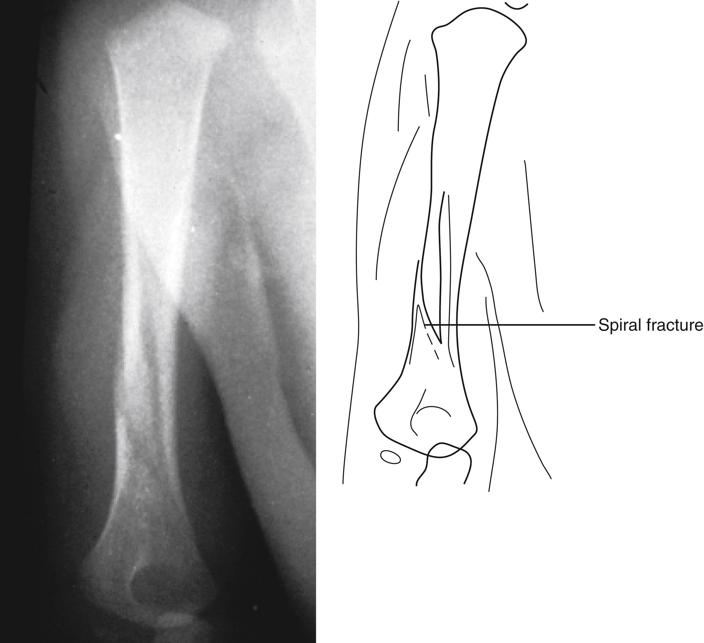 Fig. 22.22, Spiral fracture of the humerus. The fracture line takes a curvilinear course around the axis of the bone.