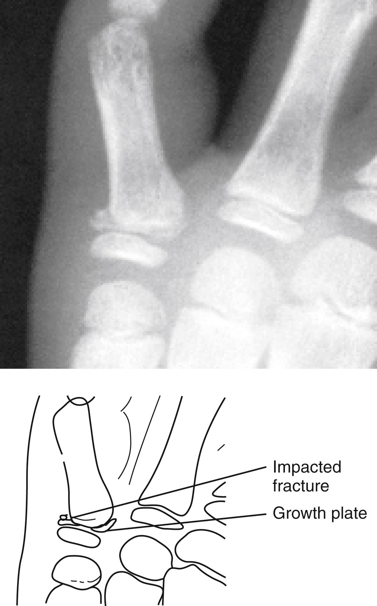 Fig. 22.23, Impacted fracture of the base of the proximal phalanx resulting from axial loading. The fracture line is indistinct, and the fragments appear to be crushed together. The fracture does not actually involve the growth plate but is located just distal to it in the proximal metaphysis.