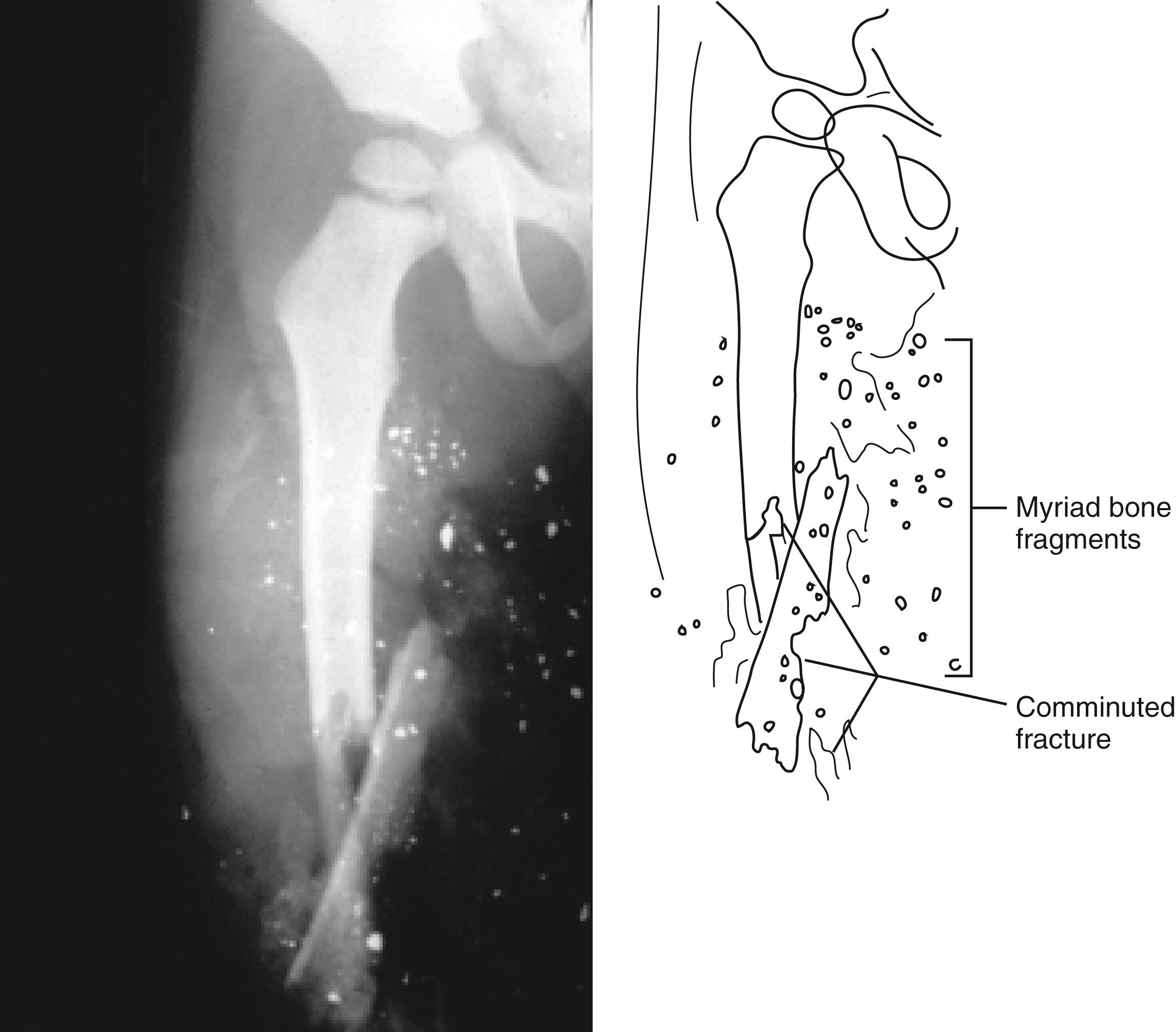 Fig. 22.24, Comminuted fracture of the femur secondary to a gunshot wound. Notice the numerous small fragments of bone in the adjacent soft tissues.