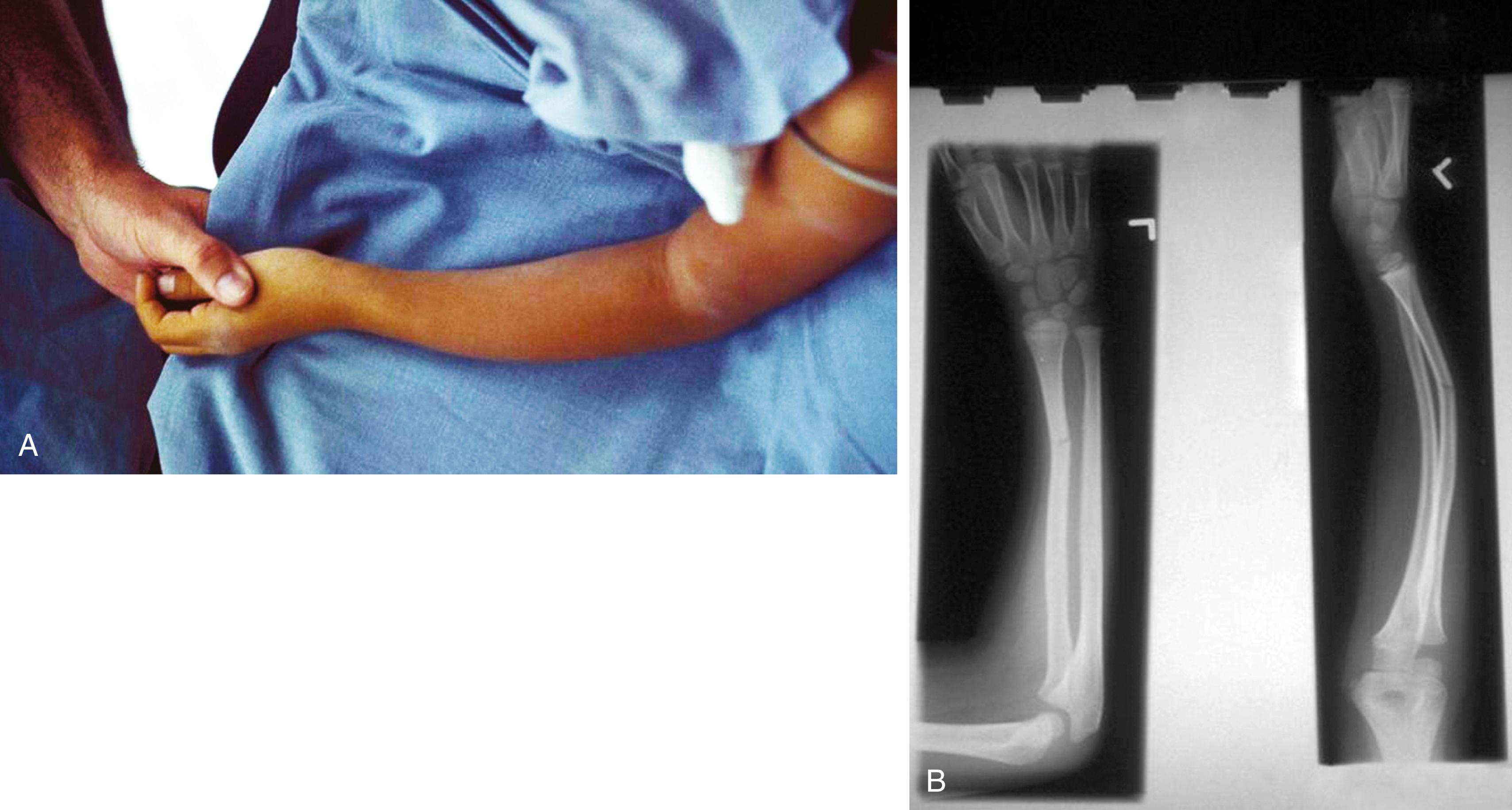 Fig. 22.25, Plastic deformation. (A) While playing soccer, this school-age child fell onto his outstretched arm. On impact another player who fell with him landed on the arm, resulting in this bowing deformity of the forearm. (B) On x-ray plastic deformation of both the ulna and radius are seen, along with a greenstick fracture of the radius. This necessitated manipulation under anesthesia to straighten the arm before casting.