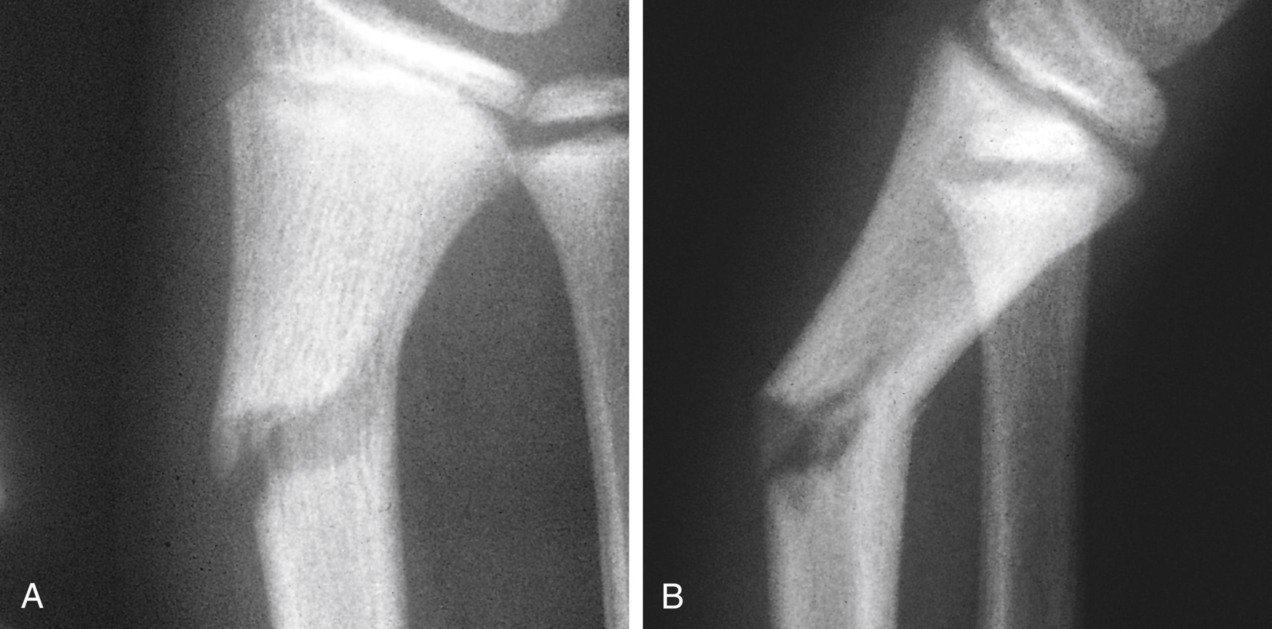 Fig. 22.26, Greenstick fracture of the distal radius. (A) In this anteroposterior view of the distal radius, a fracture line is seen that is complete except for a portion of the cortex on the compression side of the fracture. (B) The lateral radiograph demonstrates more clearly the disrupted and compressed cortices. This resulted from a fall on the outstretched arm with the wrist in dorsiflexion.