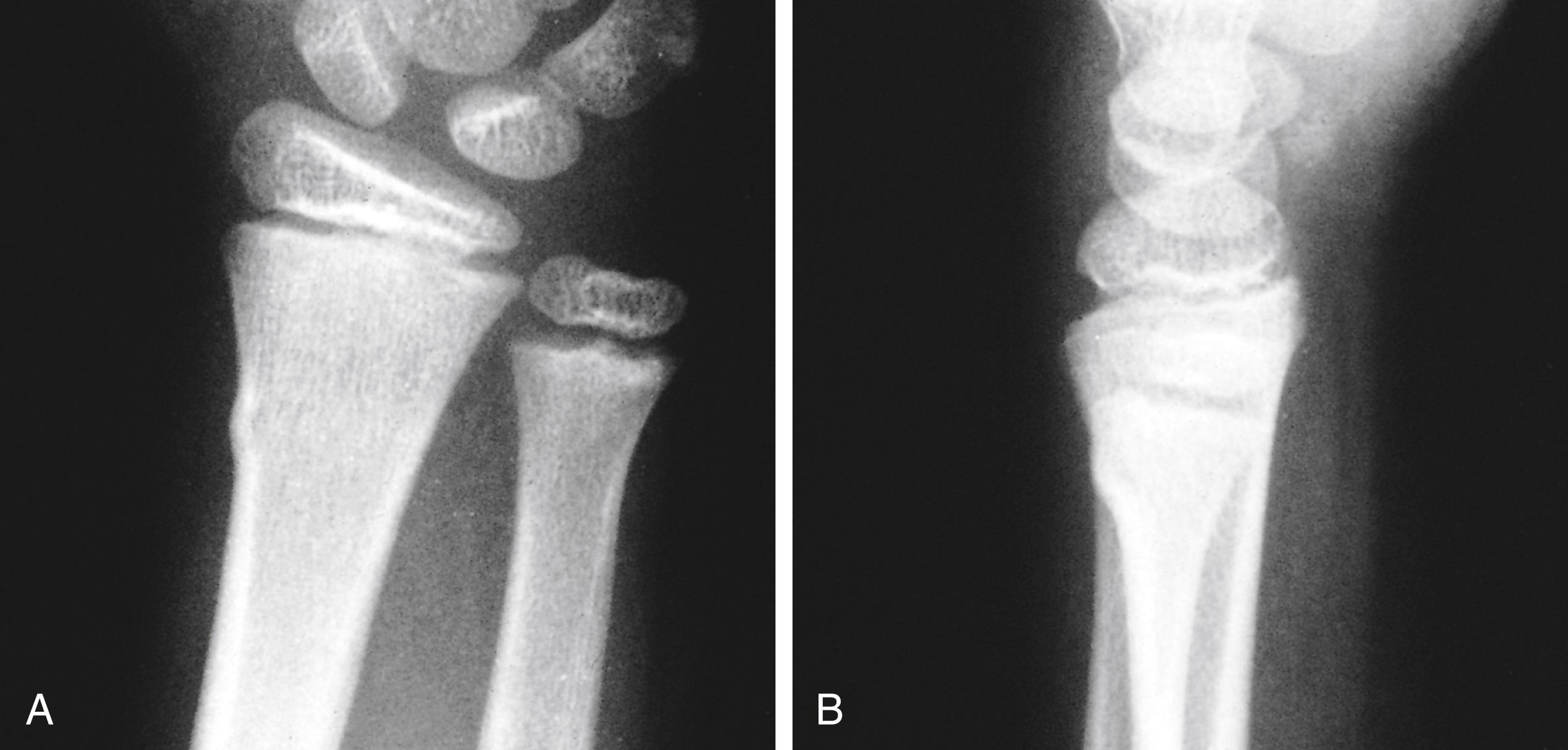 Fig. 22.27, Torus fracture of the distal radius resulting from a fall on an outstretched arm. (A) An anteroposterior radiograph of the wrist shows a minor torus or buckle fracture of the radius. (B) The lateral radiograph shows the dorsal location of the deformity. This injury can be expected to completely remodel.