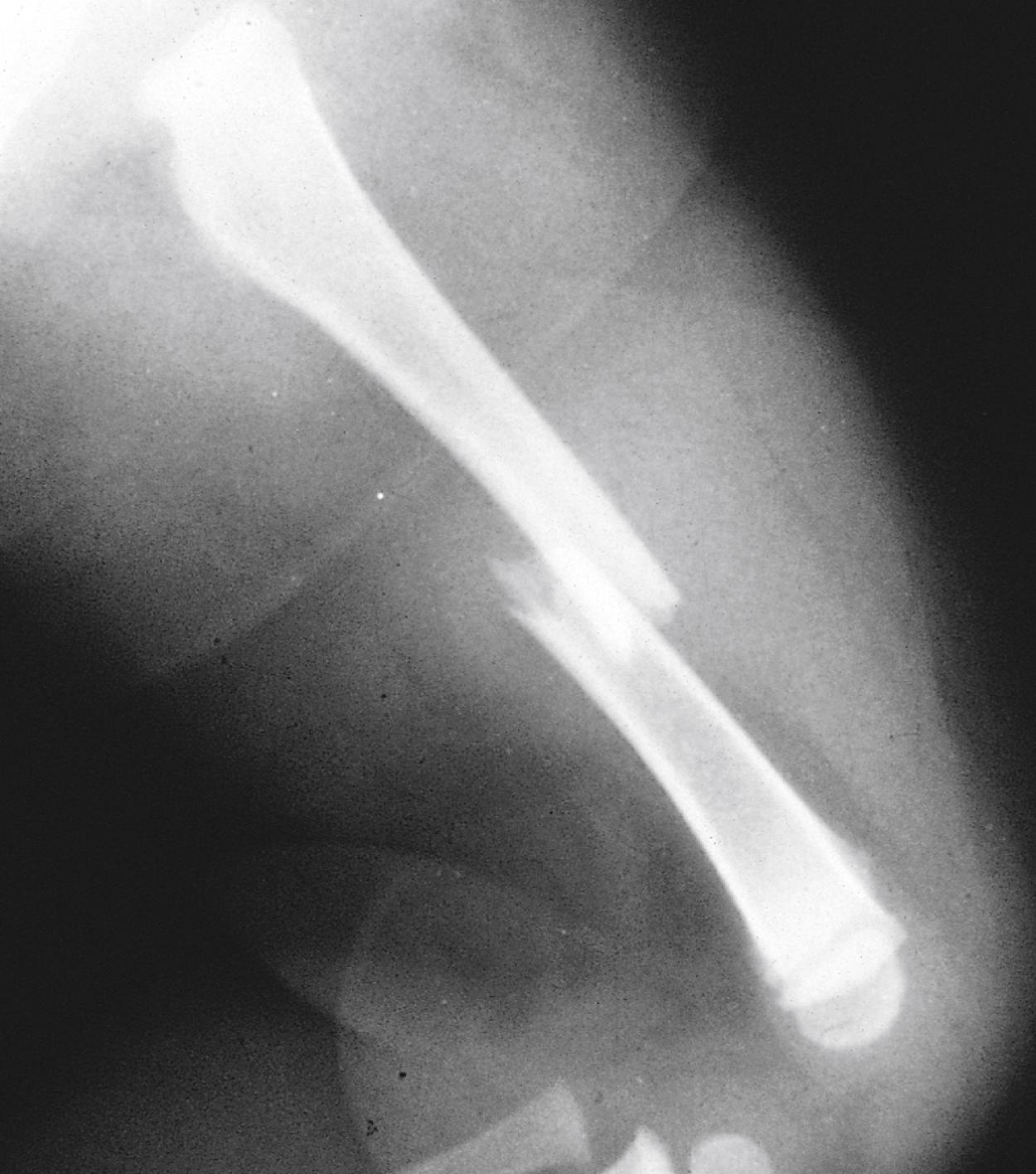 Fig. 22.28, Diaphyseal fracture. A transverse fracture line crosses the diaphyseal region of the femur. A moderate amount of overlap exists at the fracture site.