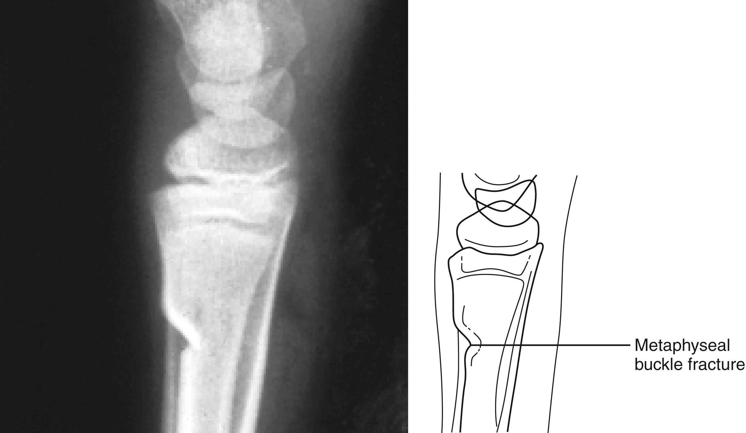 Fig. 22.29, Metaphyseal fracture. This lateral radiograph of the wrist shows a dorsal buckle fracture of the distal radial metaphysis. This fracture resulted from a fall on the outstretched arm with the wrist dorsiflexed and is a common injury in children.