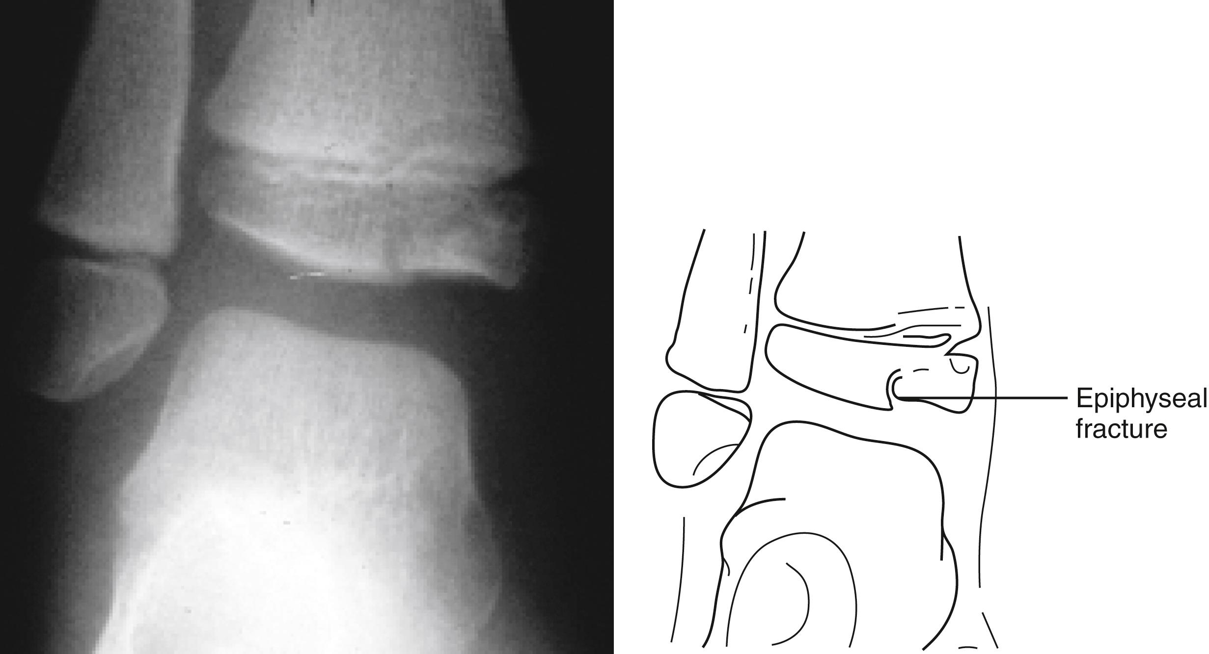 Fig. 22.30, Epiphyseal fracture. A fracture involving the medial aspect of the epiphysis of the distal tibia is seen in this anteroposterior radiograph of the ankle in a 4-year-old girl. A slight step-off is present at the articular surface. This could also be classified as a Salter-Harris type III fracture.