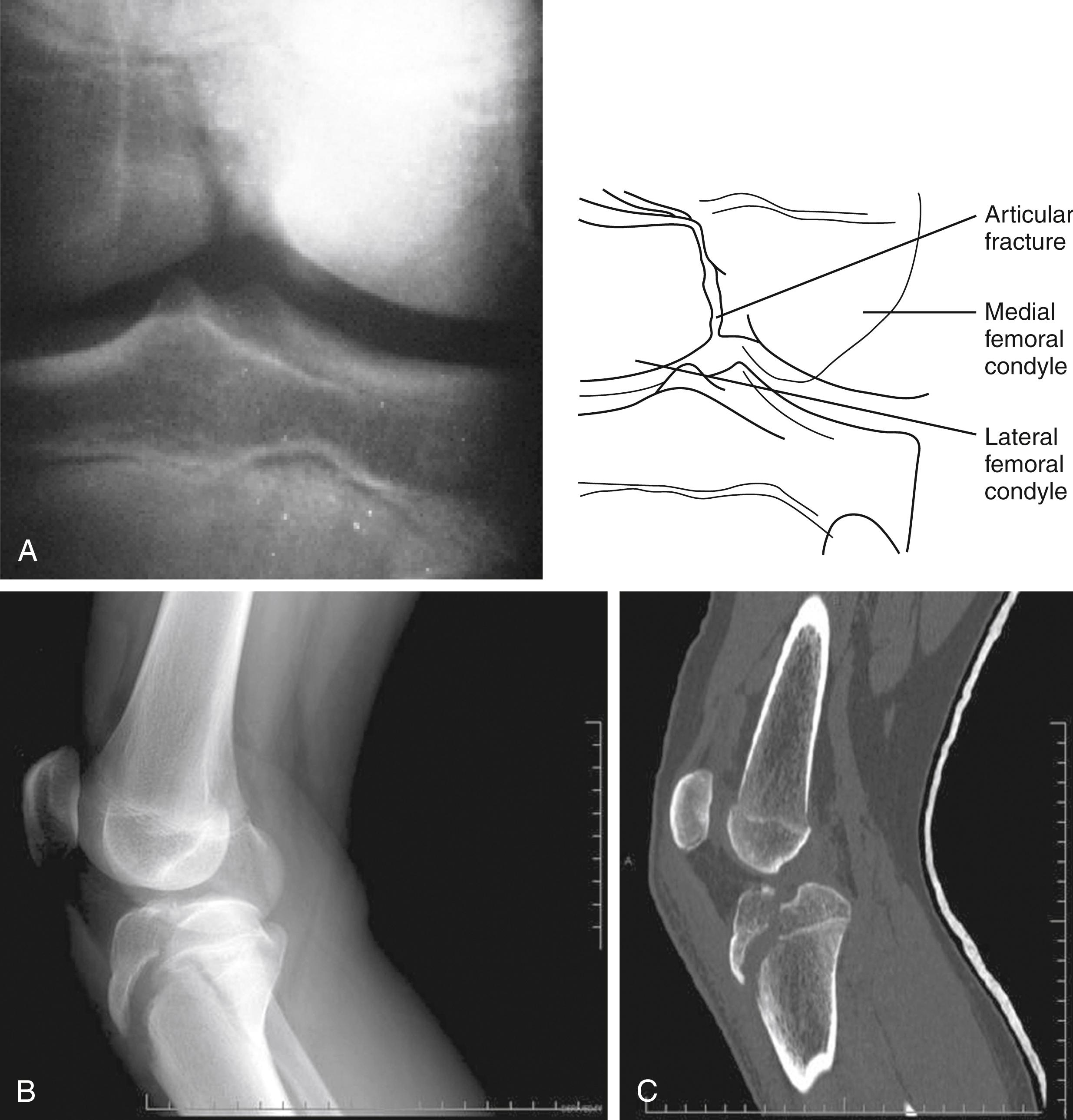 Fig. 22.31, Articular fractures. (A) This anteroposterior view of the knee demonstrates intraarticular extension of a fracture line that exits at the junction of the medial and lateral femoral condyles. The condyles are separated by only a few millimeters. This can also be termed an intercondylar fracture. (B) On coming down from a rebound, a 14-year-old basketball player landed with a twist with his knee in extension. The lateral radiograph demonstrates intraarticular extension of a fracture line that starts at the tibial tubercle and exits in the middle of the knee joint. (C) On computed tomography scan, the degree of intraarticular displacement of the fracture is better appreciated.