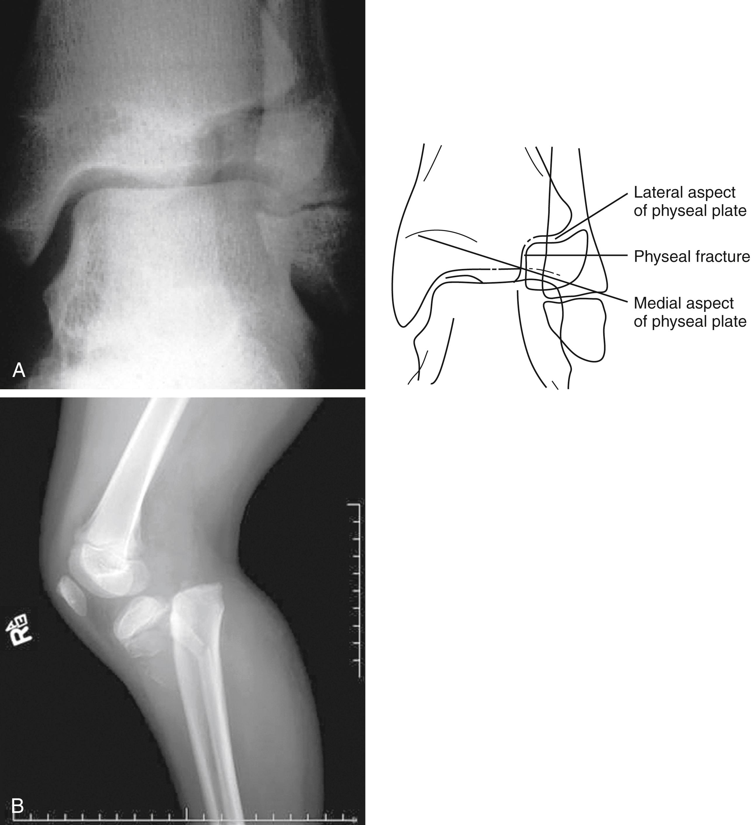 Fig. 22.32, Physeal fractures. (A) A fracture of the lateral aspect of the tibial epiphysis through the lateral aspect of the physeal plate is seen in this anteroposterior view of the ankle of a 13-year-old boy. Also called a Tillaux fracture, this pattern is seen in adolescents in whom the medial aspect of the distal tibial physis has closed but not the lateral aspect. It can also be classified as a Salter-Harris type III fracture. (B) A 7-year-old restrained backseat passenger involved in a head-on collision motor vehicle accident suffered a direct impact to the front of his lower leg due to violent displacement of the front seat. This resulted in shearing of the proximal tibial epiphysis from the metaphysis. The lateral view of the knee demonstrates complete separation of the epiphysis from most of the metaphysis. This degree of posterior displacement of the metaphysis can be associated with compression of the popliteal artery. This can also be classified as a Salter-Harris type II fracture because a small metaphyseal fragment remains attached to the epiphysis.