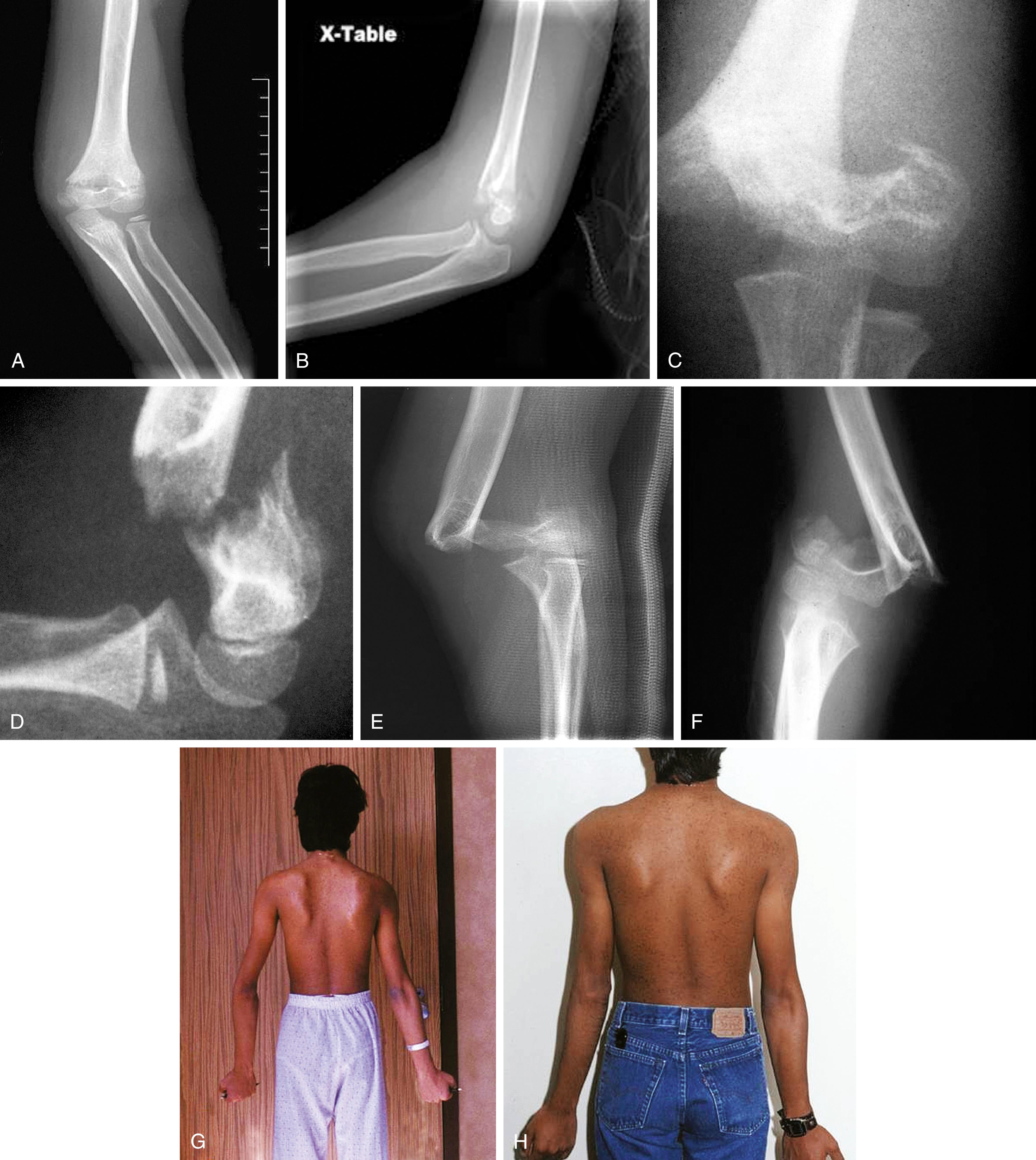 Fig. 22.34, Supracondylar humerus fractures. These injuries are typically the result of a fall backward onto an outstretched arm with the elbow in hyperextension. This transmits the force of the impact to the distal humerus, driving the distal fragment posteriorly. Most require surgery to realign, reduce, and stabilize the fracture. (A) This 8-year-old fell backward off a swing, landing on his hand with his elbow extended. The anteroposterior radiograph shows the fracture line crossing through the olecranon fossa in the supracondylar region of the distal humerus. Although there is marked soft tissue swelling, degree of displacement appears mild. (B) In the lateral view, moderate posterior displacement of the distal fragment is evident. There is also a positive fat pad sign. (C) In another boy, after a more severe backward fall, the anteroposterior radiograph shows the distal fragment displaced radially. (D) In the lateral view, significant posterior displacement is evident. (E and F) In this case an 8-year-old fell backward from a barn window onto his extended arm. This resulted in a severely displaced (type III) supracondylar fracture with associated injury to the brachial artery and vascular insufficiency of the forearm and hand, manifest by a cool hand and absent pulses. The distal fragment is displaced posterolaterally. In such cases, the brachial artery may be placed on “stretch” over the proximal fragment or may be entrapped between fragments. This is a true surgical emergency requiring immediate surgery to reduce the fracture and restore distal blood flow. (G) This boy has cubitus valgus deformity of his left elbow as a result of incorrect healing of a supracondylar fracture. (H) This was corrected by a distal humerus osteotomy, restoring normal contour to the elbow.