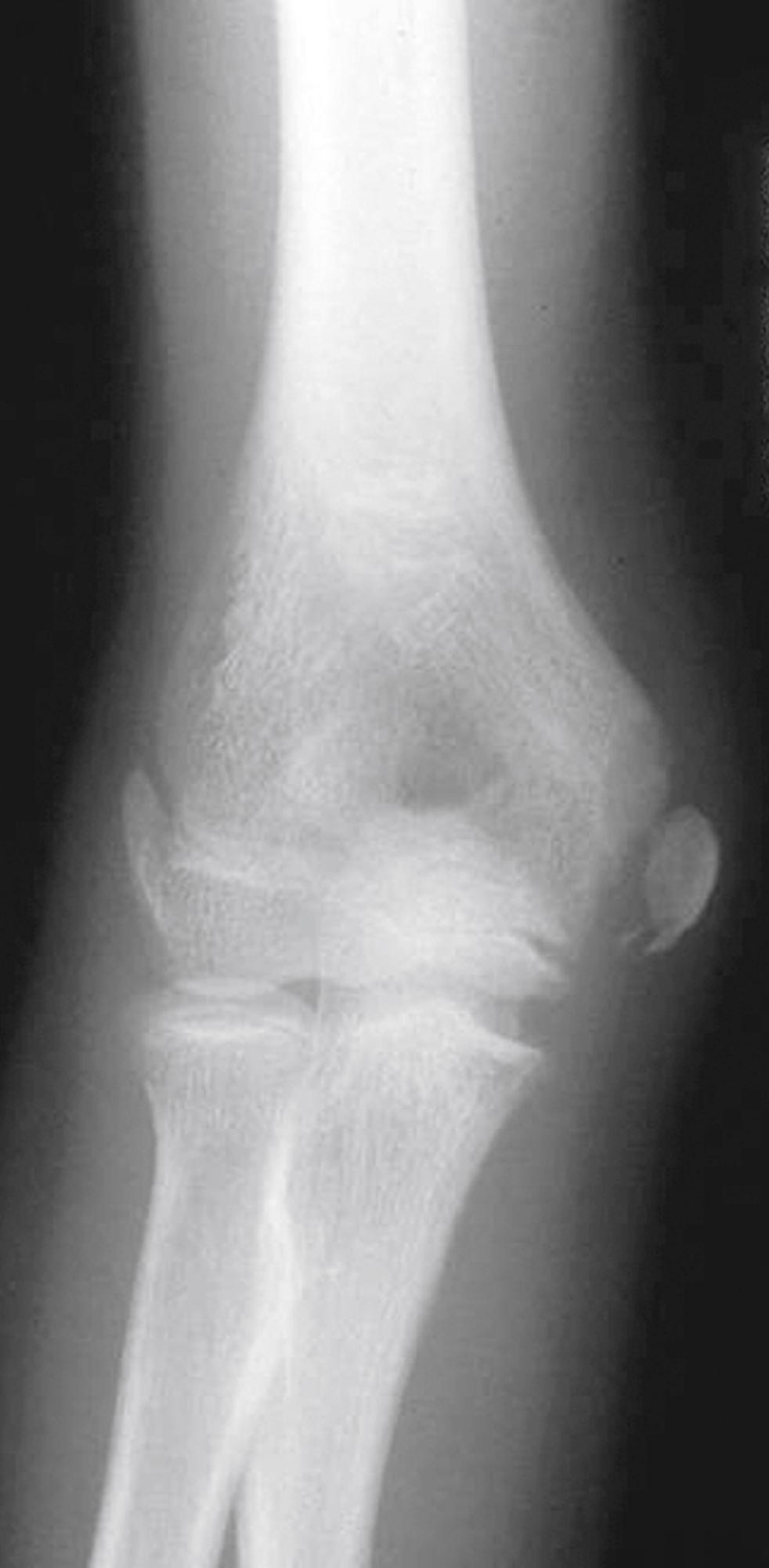 Fig. 22.35, Epicondylar fracture. This 10-year-old tripped while playing soccer and fell onto his arm with a valgus strain on the elbow. The anteroposterior radiograph shows a moderately displaced medial epicondylar fracture. These injuries are sometimes associated with dislocation of the elbow, in which case there is marked swelling of the entire elbow.