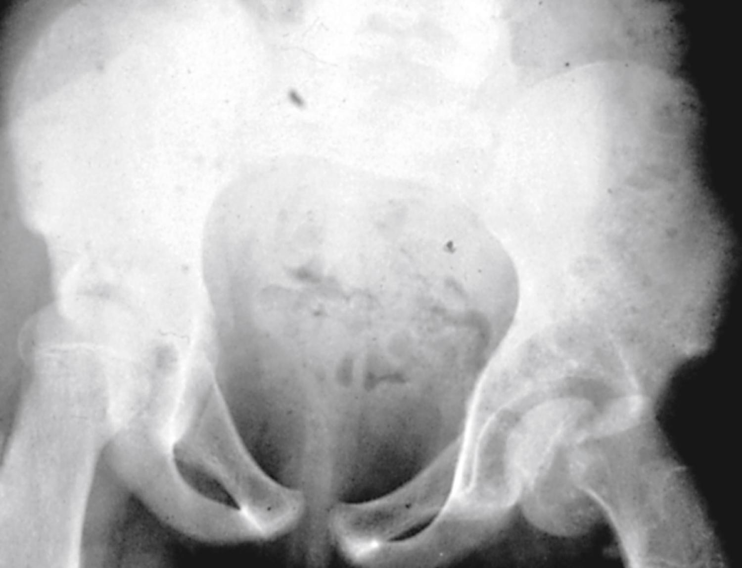 Fig. 22.36, Subcapital fracture. This anteroposterior radiograph of the pelvis shows a displaced subcapital fracture of the left femur. This particular injury may be seen acutely as the result of significant trauma or may develop slowly as a result of gradual slipping at the physeal level.