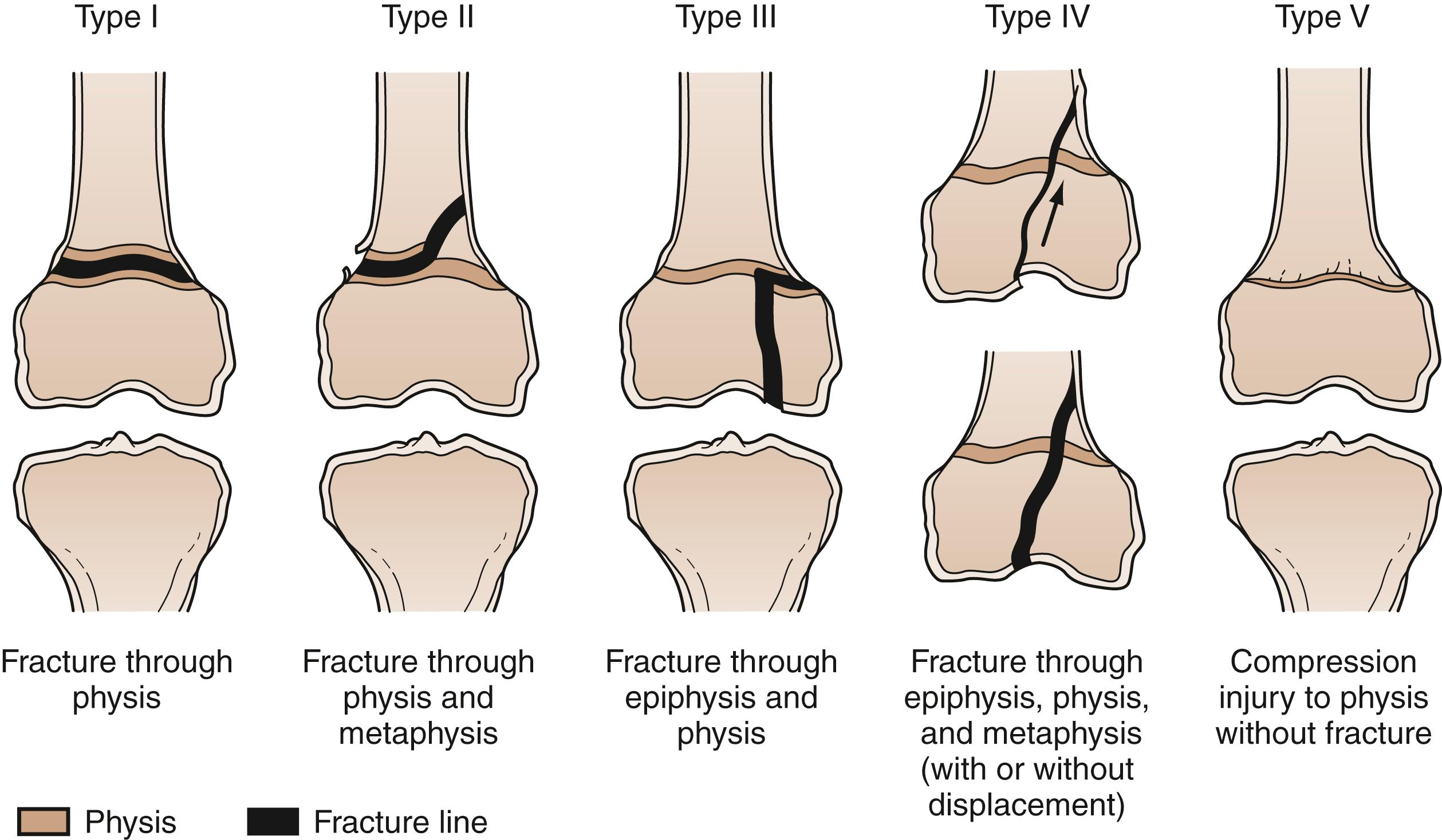 Fig. 22.37, Salter-Harris classification of physeal injuries.