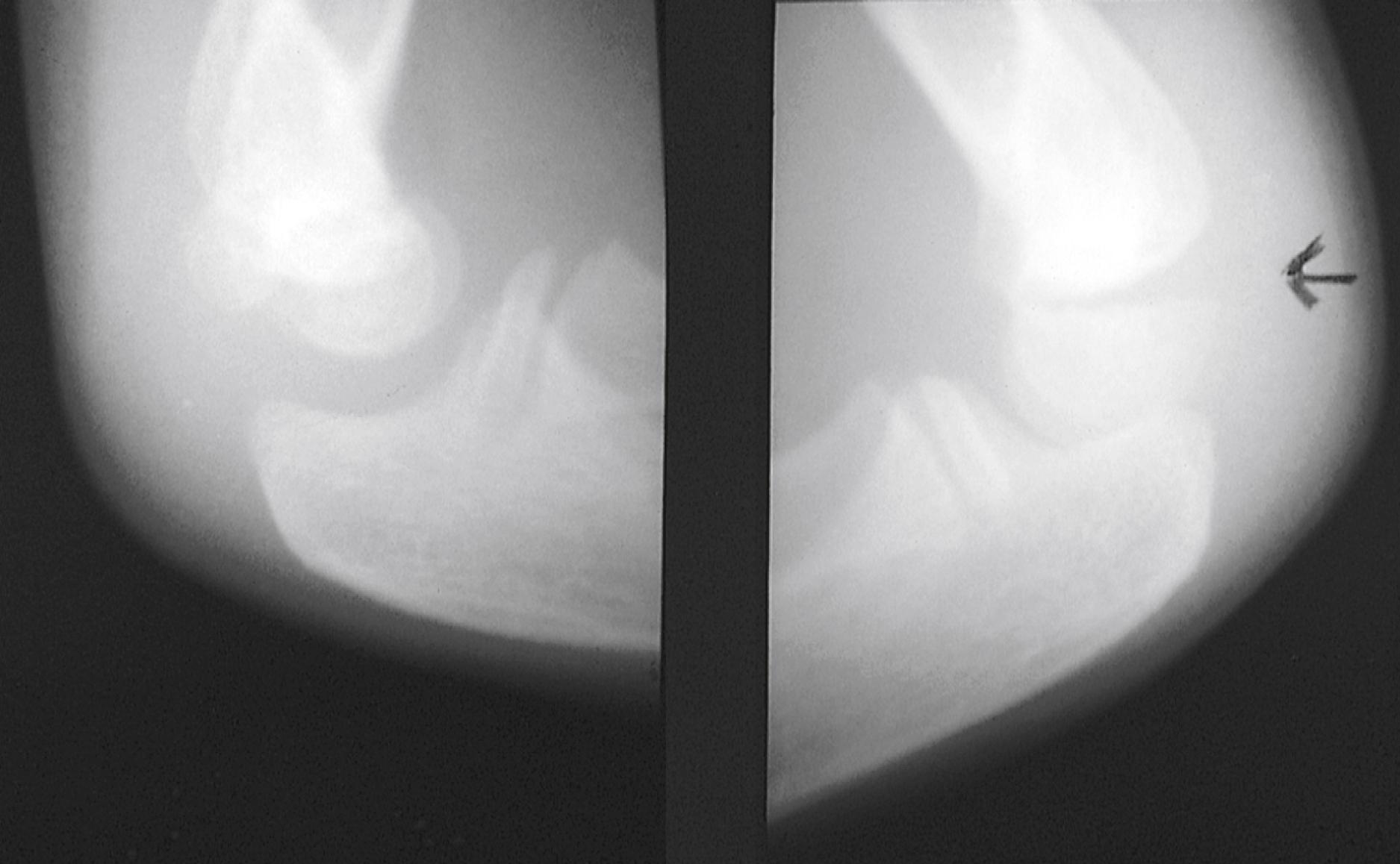 Fig. 22.38, Salter-Harris type I injury. Close inspection shows slight widening of the distal humeral epiphysis (right, arrow). Clinically, the patient had pain, tenderness, and decreased range of motion of the elbow.