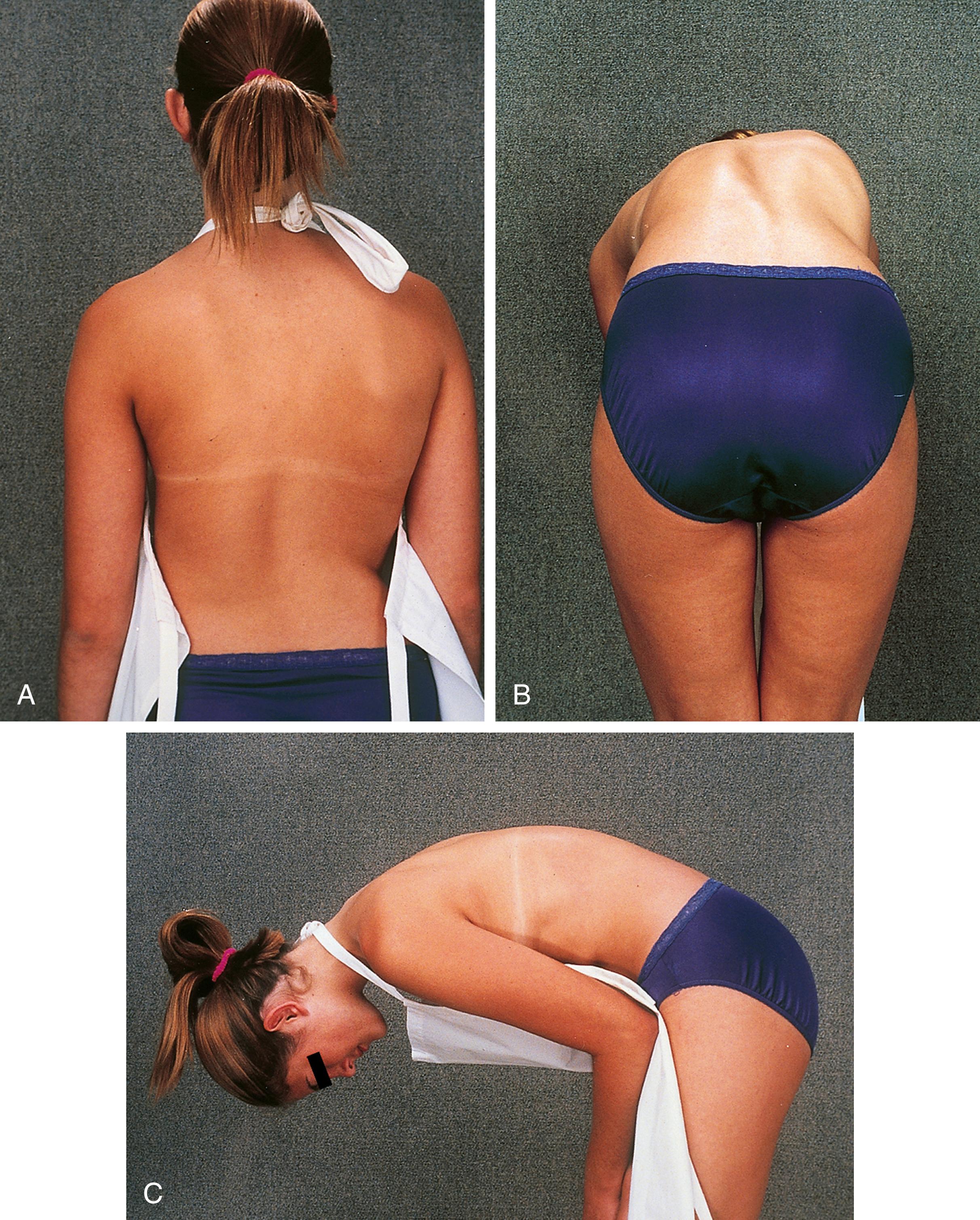 Fig. 22.4, Adams forward bend test. (A) Scoliosis can be difficult to detect on observation of the standing patient. (B) With the child bending forward and observed from behind, it is much easier to appreciate the asymmetrical trunk rotation seen in scoliosis. (C) Viewing the patient from the side, one can more easily see even subtle degrees of kyphosis and note lack of reversal of normal lordosis.