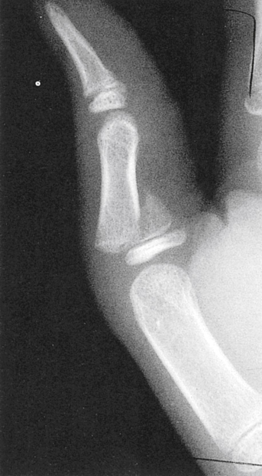Fig. 22.39, Salter-Harris type II injury. On this lateral radiograph of the thumb, the fracture is seen to involve the proximal phalanx. The fracture line runs through the physis and exits through the metaphysis on the side opposite the site of fracture initiation. A fragment consisting of the entire epiphysis with the attached metaphyseal fragment is produced.