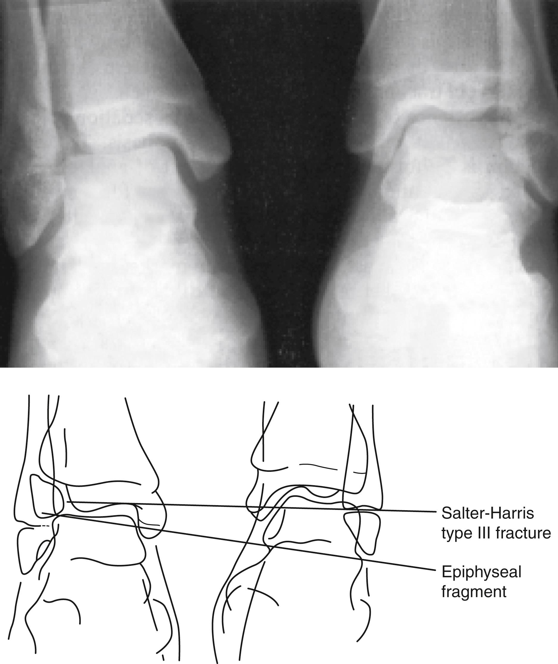 Fig. 22.40, Salter-Harris type III injury. Comparison view of both ankles reveals a fracture involving the lateral aspect of the right distal tibial epiphysis. This configuration creates a separate fragment without any connection to the metaphysis.