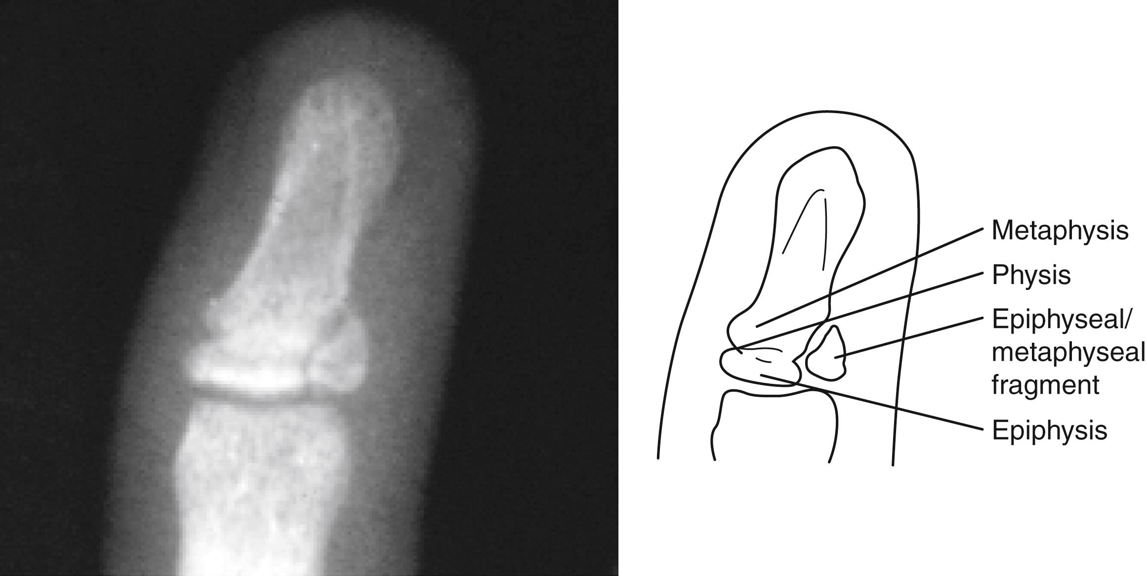 Fig. 22.41, Salter-Harris type IV injury. This patient incurred a fracture of the distal phalanx of the index finger. The fracture line starts at the articular surface, runs through the epiphysis across the physis, and exits through the metaphysis. A single fragment consisting of the epiphysis and the attached metaphysis is thus created.