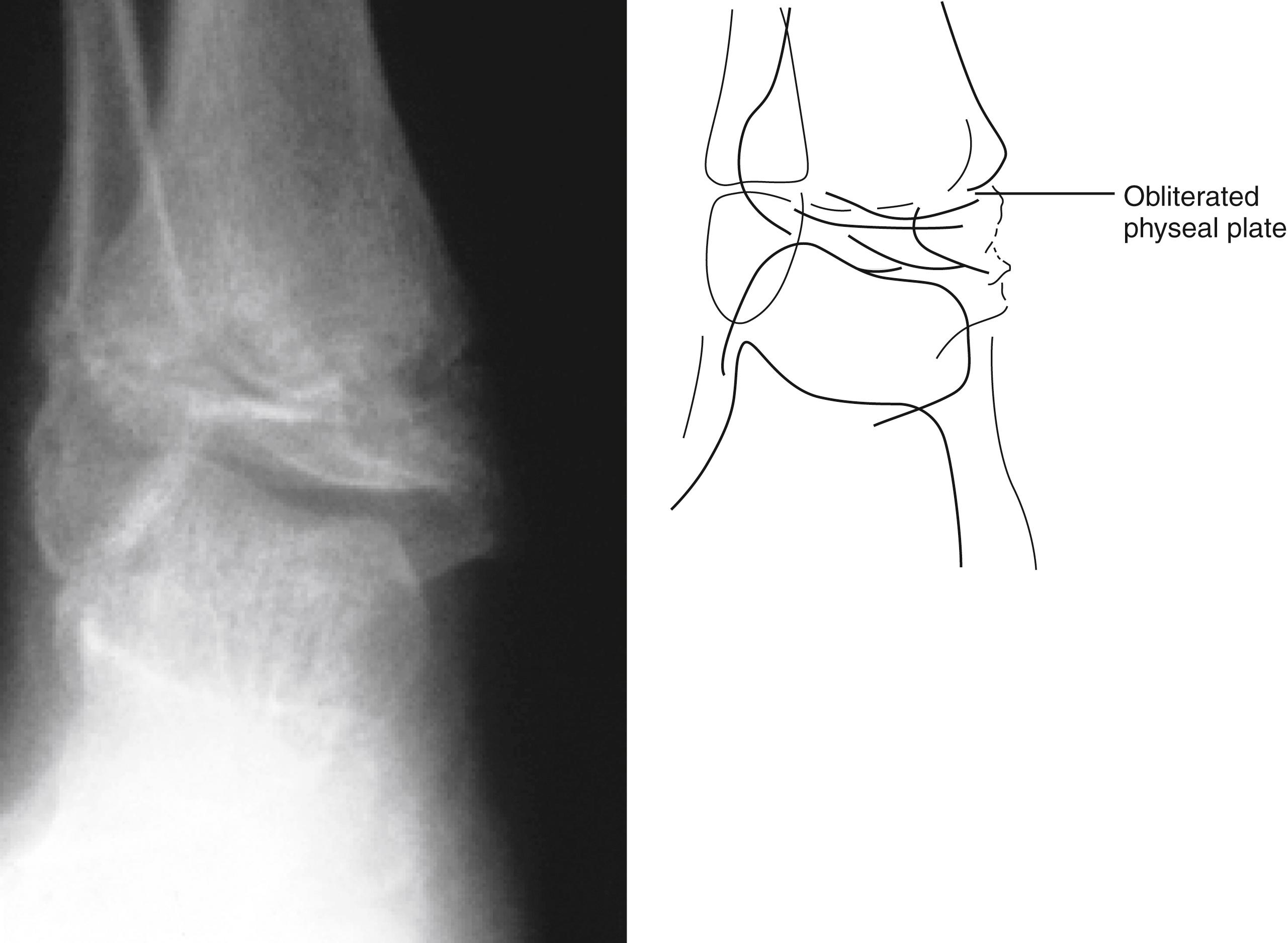 Fig. 22.42, Salter-Harris type V injury. This anteroposterior radiograph of the ankle taken several weeks after a crush injury sustained in an automobile accident reveals obliteration of the distal tibial physeal plate. As is often the case, original radiographs taken at the time of injury looked normal. This fracture must be suspected on clinical grounds, and the patient treated and monitored accordingly.