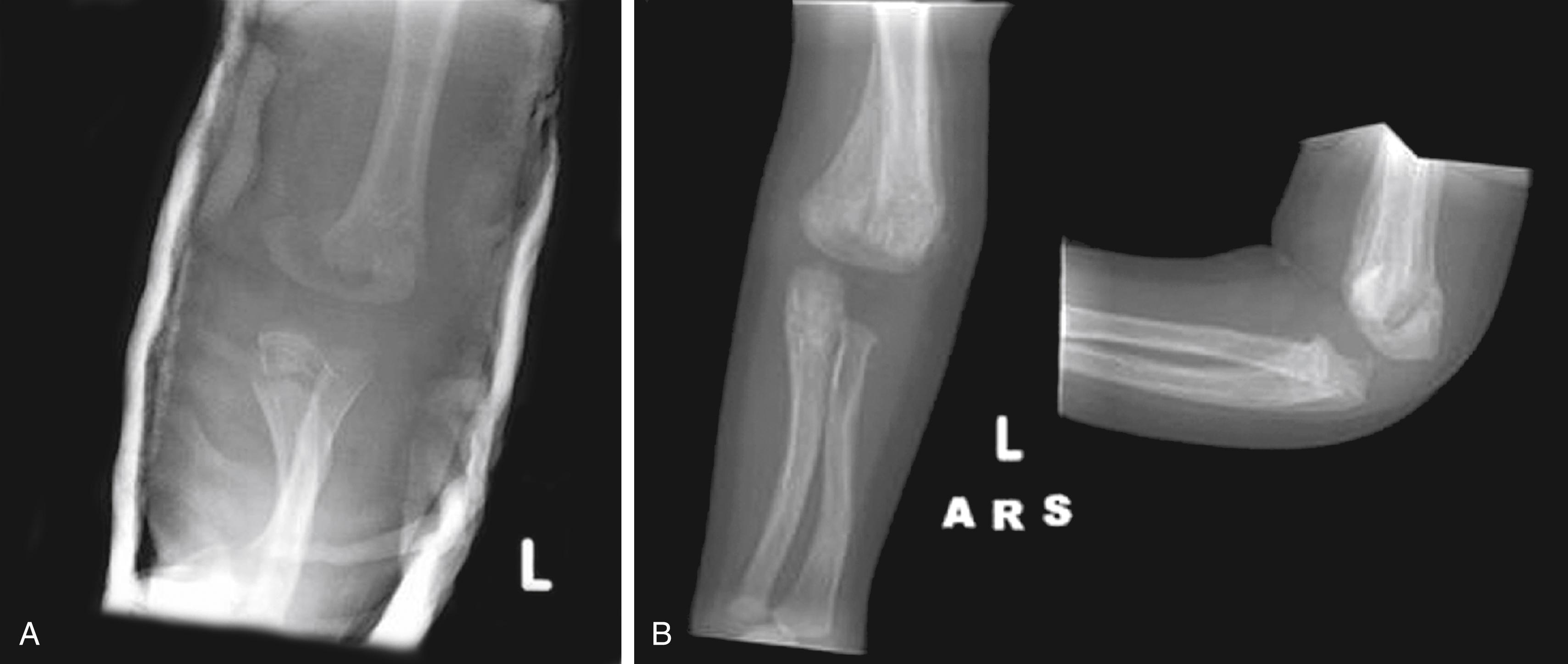 Fig. 22.44, Inflicted elbow fractures. This 10-month-old was brought in with a history of a minor fall and decreased use of his arm. (A) However, radiographs revealed displaced transverse fractures of both the distal humerus and proximal ulna along with marked soft tissue swelling. These findings were incompatible with the reported mechanism of injury and instead were the result of grabbing the arm and yanking the elbow into hyperextension with severe force. (B) Follow-up films 1 month later show prolific subperiosteal new bone formation.