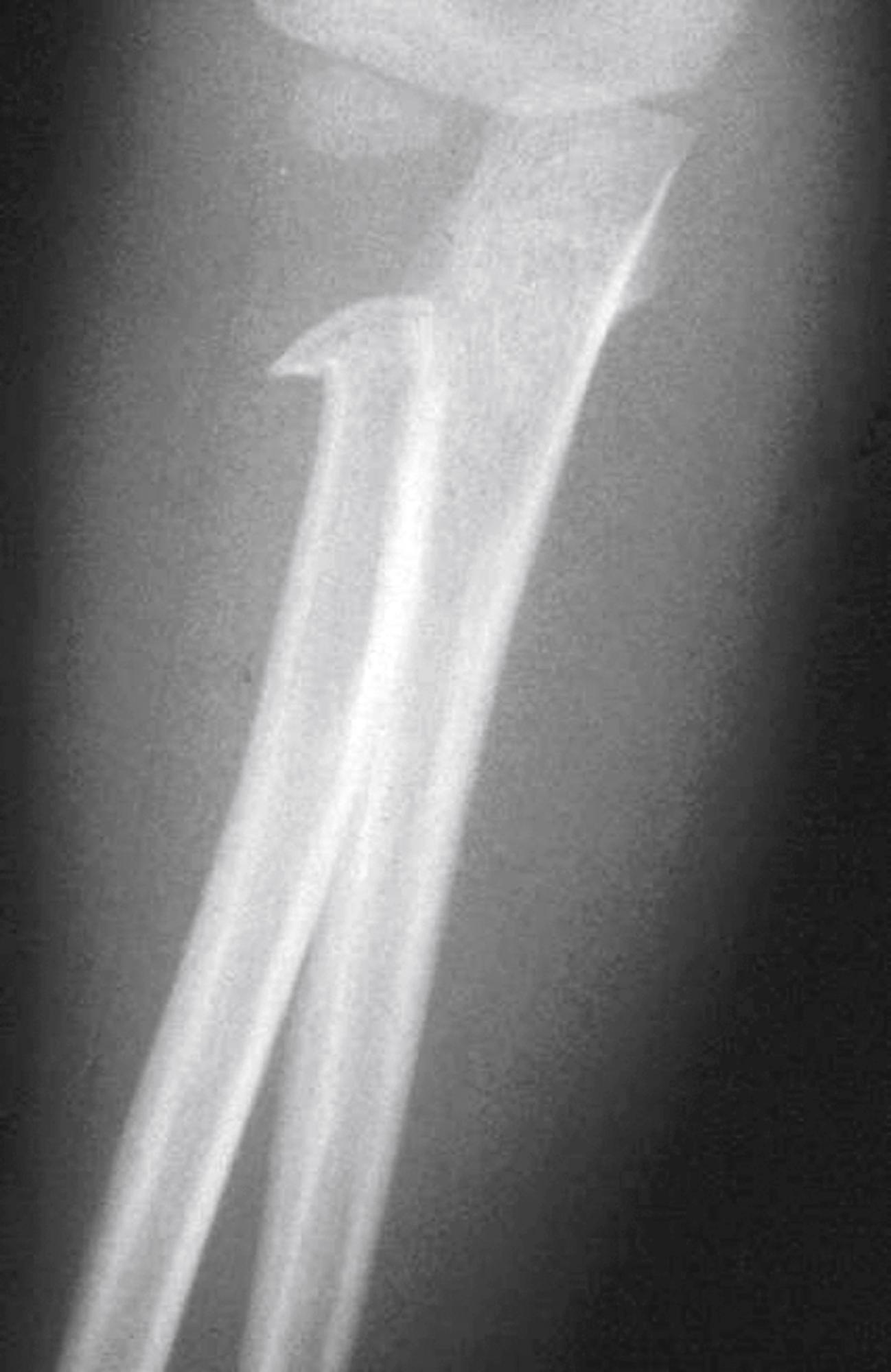 Fig. 22.45, Radial neck fracture. When this 4-year-old boy fell off his bike, the position of his arm on impact resulted in transmission of a valgus force across the elbow joint, resulting in this impaction fracture of the radial neck. Radial neck fractures may require reduction to restore normal supination and pronation of the forearm.