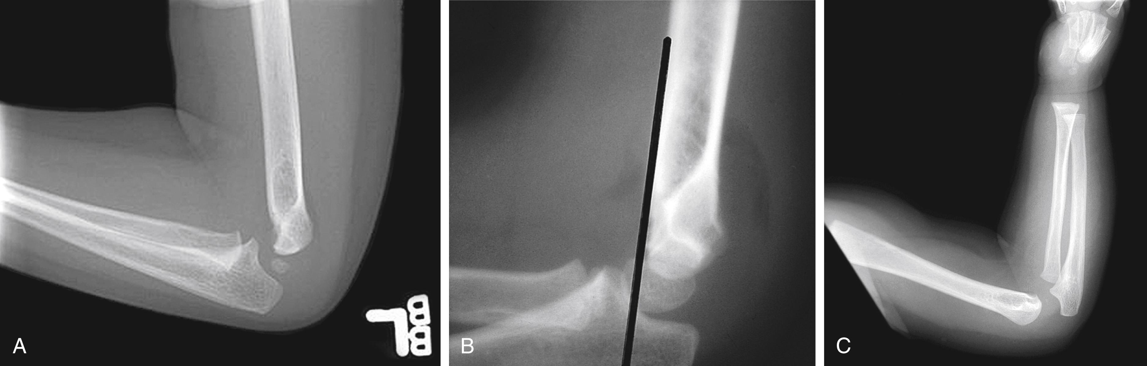 Fig. 22.46, (A) Posterior fat pad sign. Although no clear fracture line is evident in this patient with a supracondylar fracture, the posterior fat pad is readily visible, being displaced upward and outward from the posterior aspect of the distal humerus. The finding indicates the presence of a joint effusion, which after trauma is blood, and in about 70% of cases with no visible fracture line, an occult fracture is present. (B) Anterior humeral line. A line drawn through the anterior cortex of the humerus in another patient with a positive fat pad intersects the anterior third of the capitellum, indicating posterior displacement of the distal humeral fragment. (C) Normal elbow for comparison.