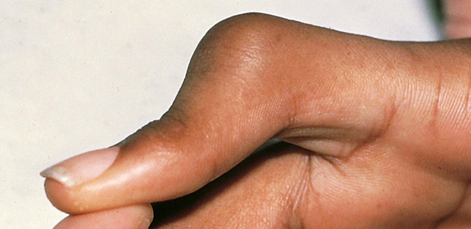 Fig. 22.87, Boutonnière deformity of the finger. A fixed flexion contracture of the proximal interphalangeal joint exists, along with hyperextension of the distal joint secondary to volar migration of the lateral bands of the extensor mechanism. This is the result of an unrecognized or inadequately treated injury to the extensor tendon at its insertion on the middle phalanx.